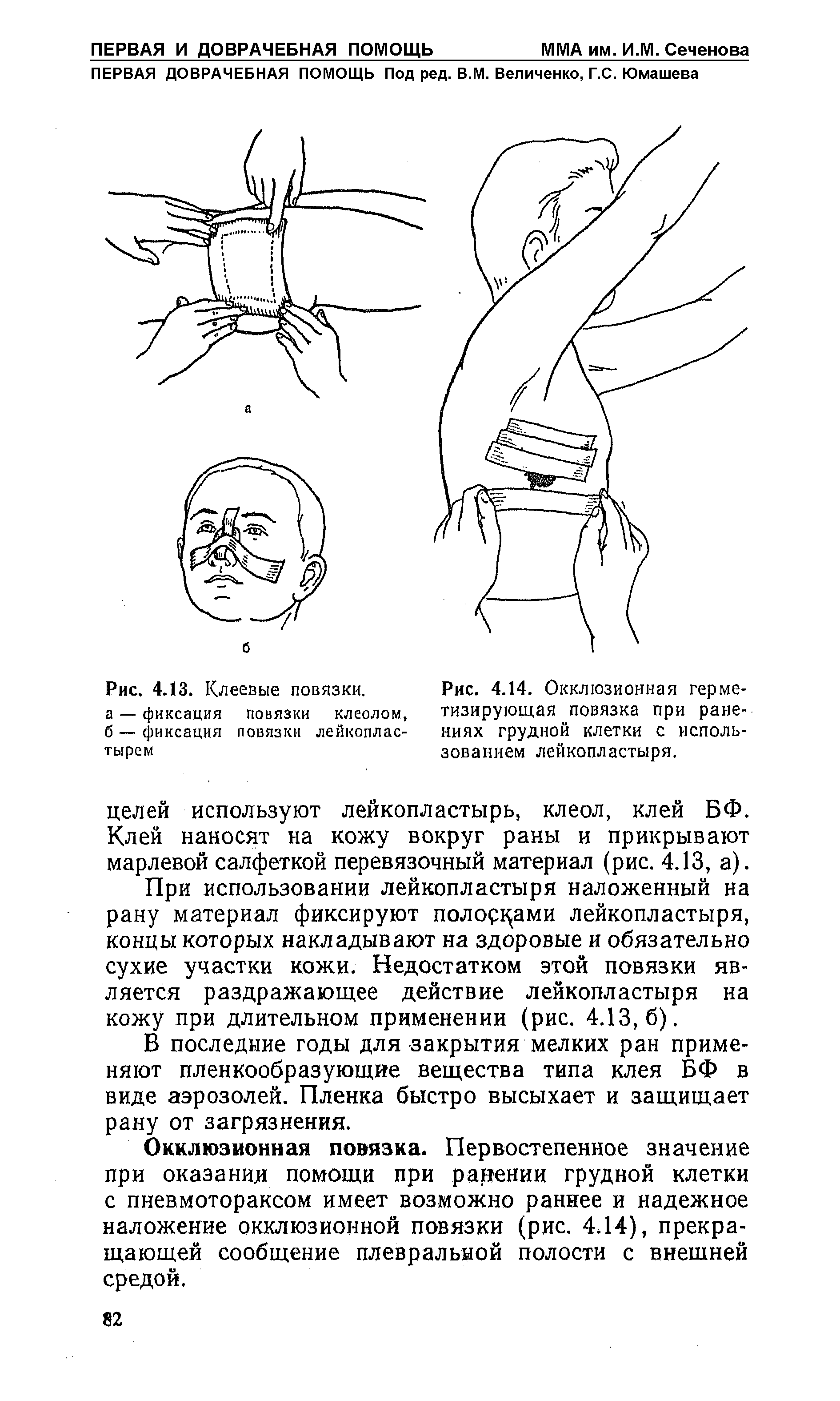 Рис. 4.14. Окклюзионная герметизирующая повязка при ранениях грудной клетки с использованием лейкопластыря.