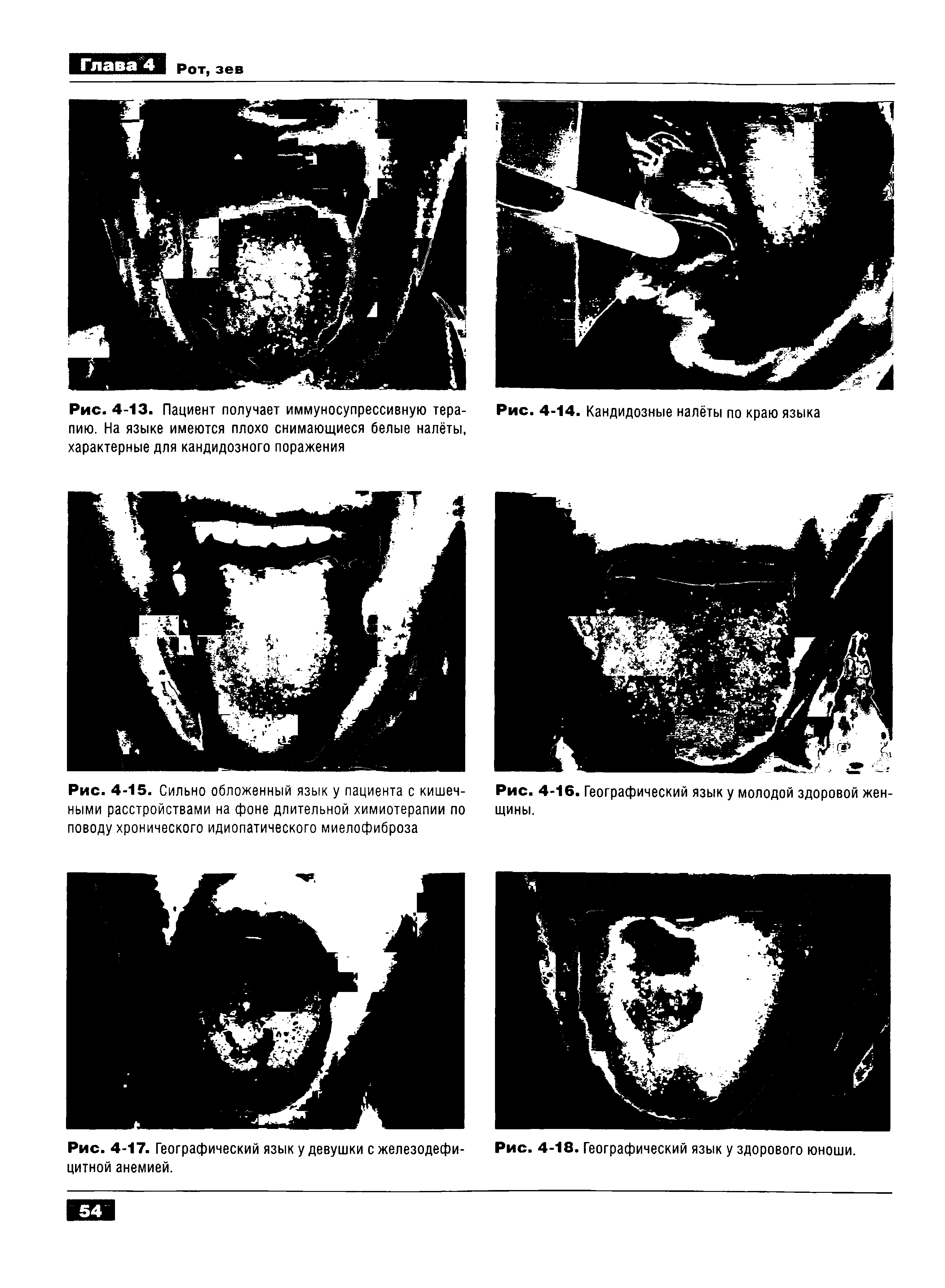 Рис. 4-15. Сильно обложенный язык у пациента с кишечными расстройствами на фоне длительной химиотерапии по поводу хронического идиопатического миелофиброза...