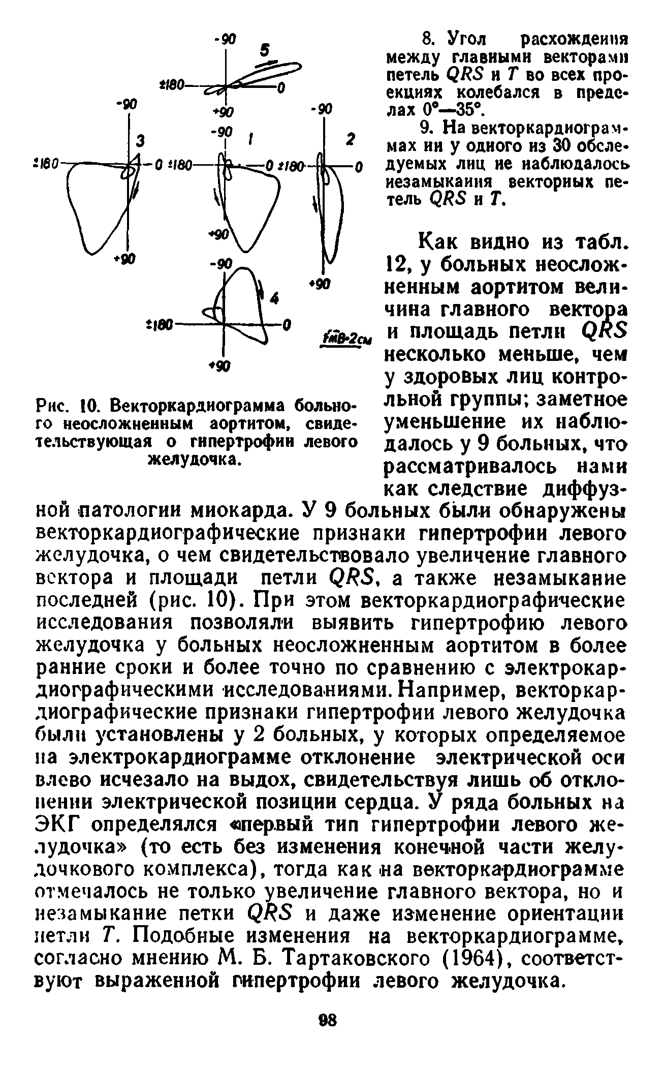 Рис. 10. Векторкардиограмма больного неосложненным аортитом, свидетельствующая о гипертрофии левого желудочка.