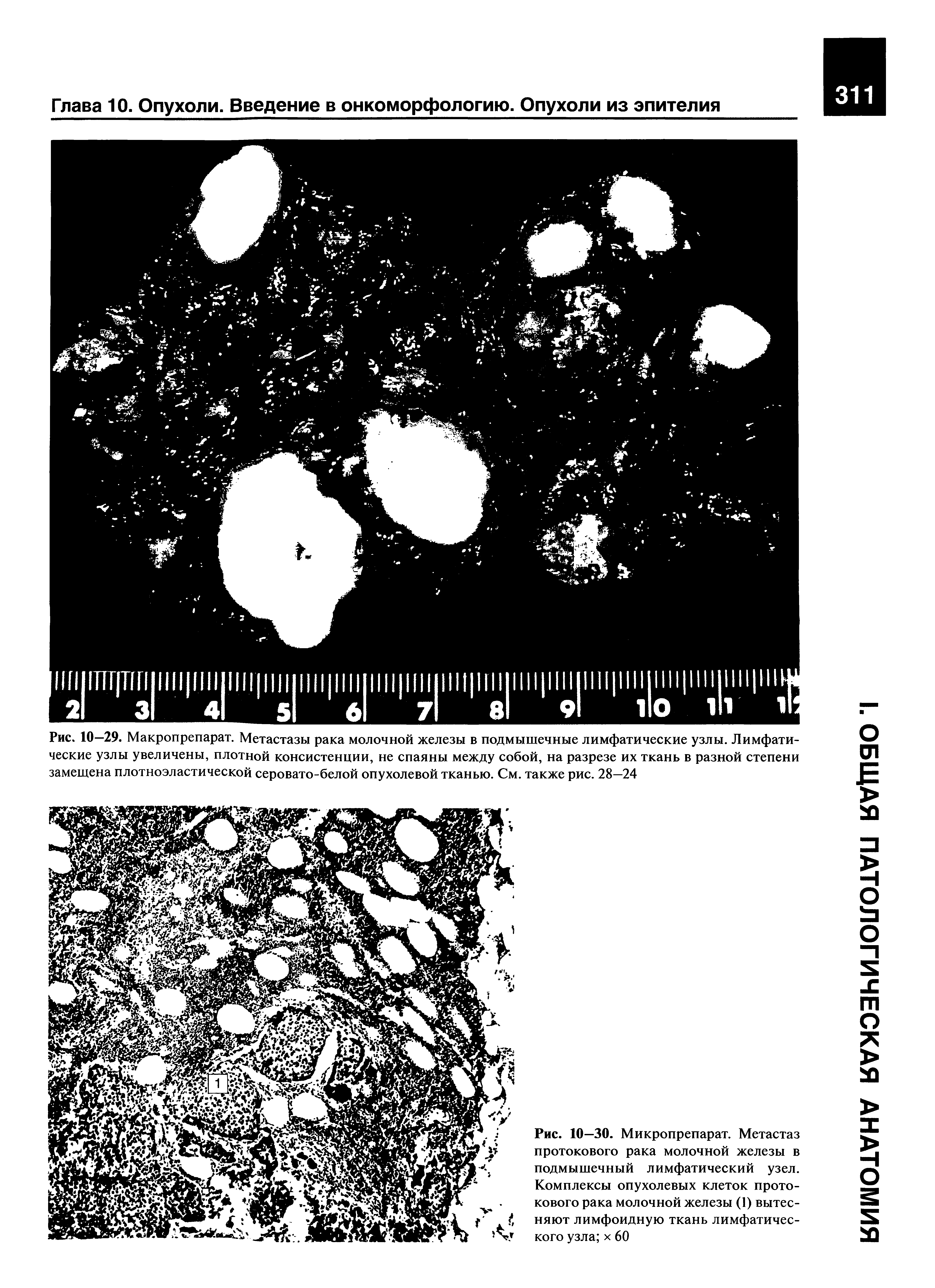 Рис. 10—30. Микропрепарат. Метастаз протокового рака молочной железы в подмышечный лимфатический узел. Комплексы опухолевых клеток протокового рака молочной железы (1) вытесняют лимфоидную ткань лимфатического узла х 60...