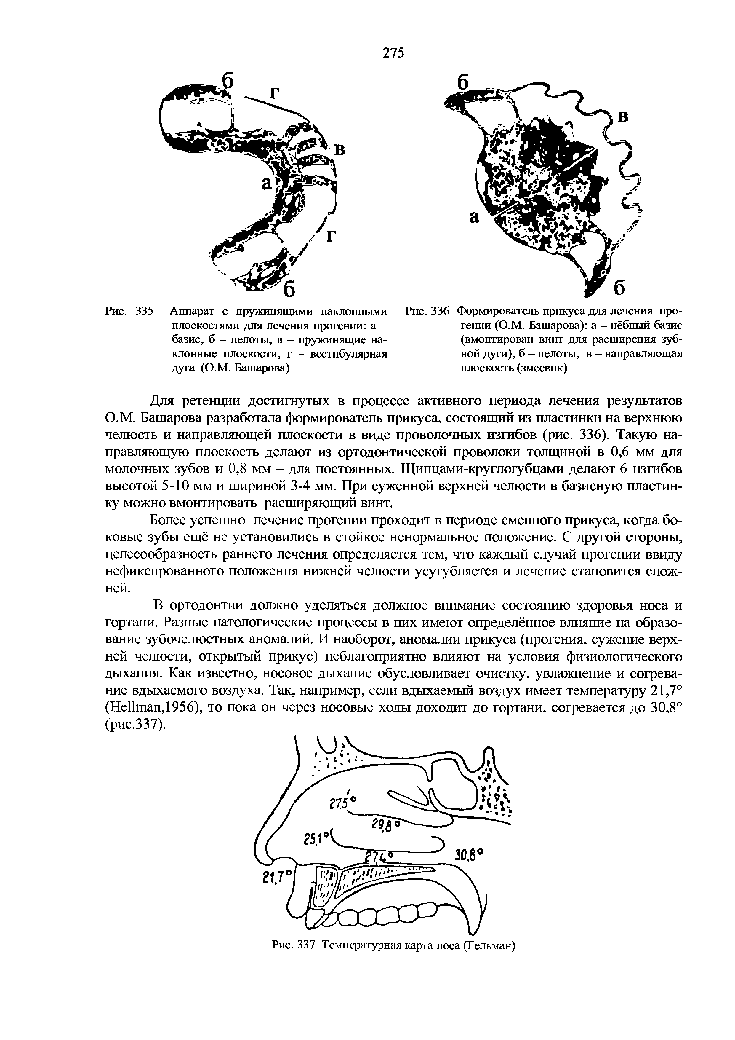 Рис. 336 Формирователь прикуса для лечения прогении (О.М. Башарова) а - нёбный базис (вмонтирован винт для расширения зубной дуги), б - пелоты, в - направляющая плоскость (змеевик)...