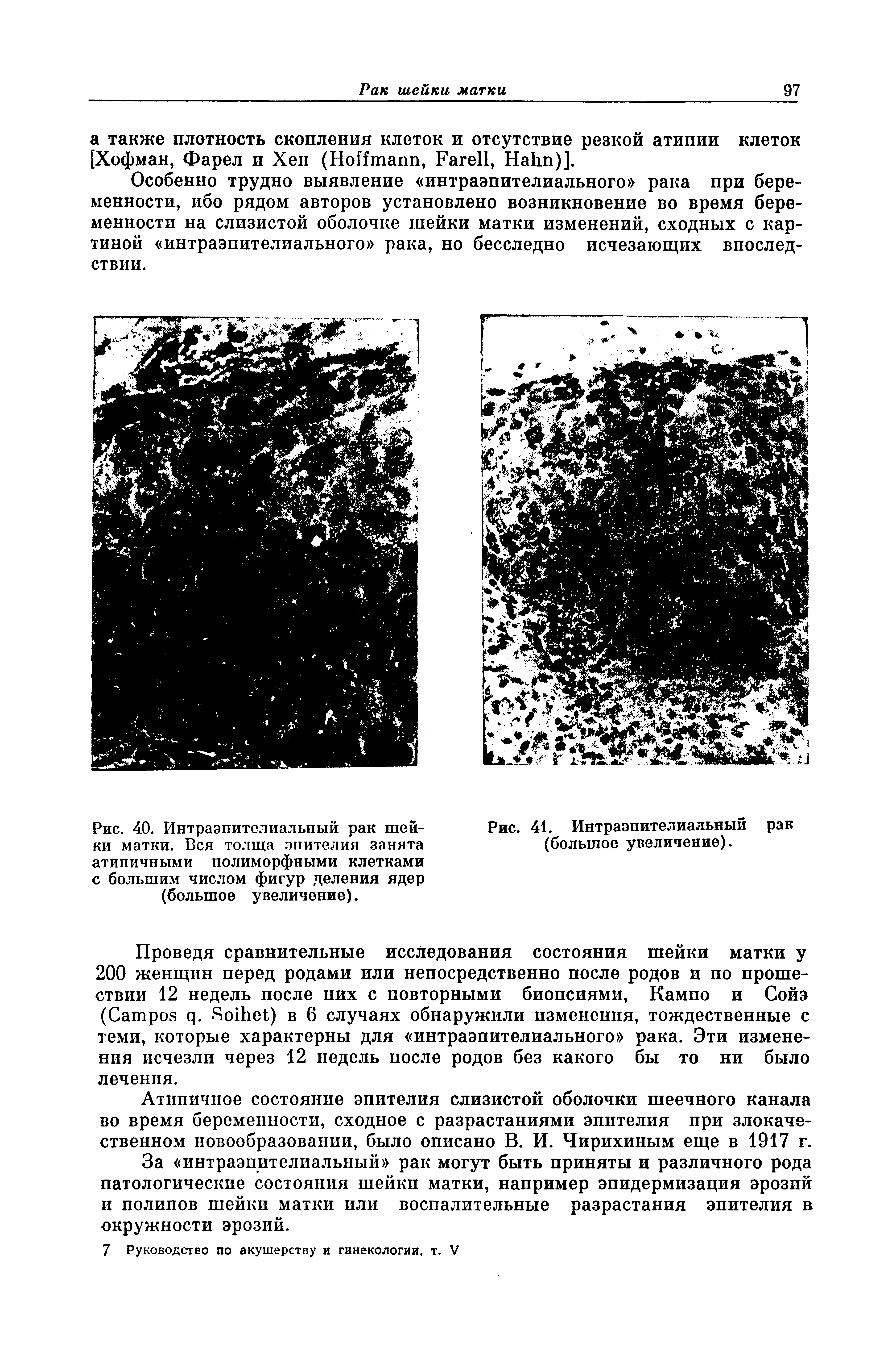 Рис. 40. Интраэпителиальный рак шейки матки. Вся толща эпителия занята атипичными полиморфными клетками с большим числом фигур деления ядер (большое увеличение).