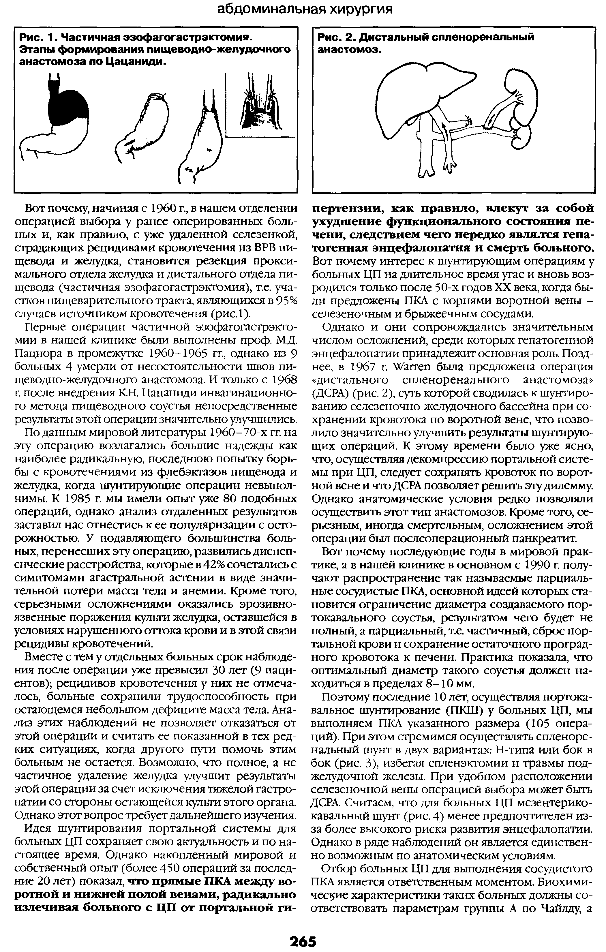 Рис. 1. Частичная эзофагогастрэктомия. Этапы формирования пищеводно-желудочного анастомоза по Цацаниди.