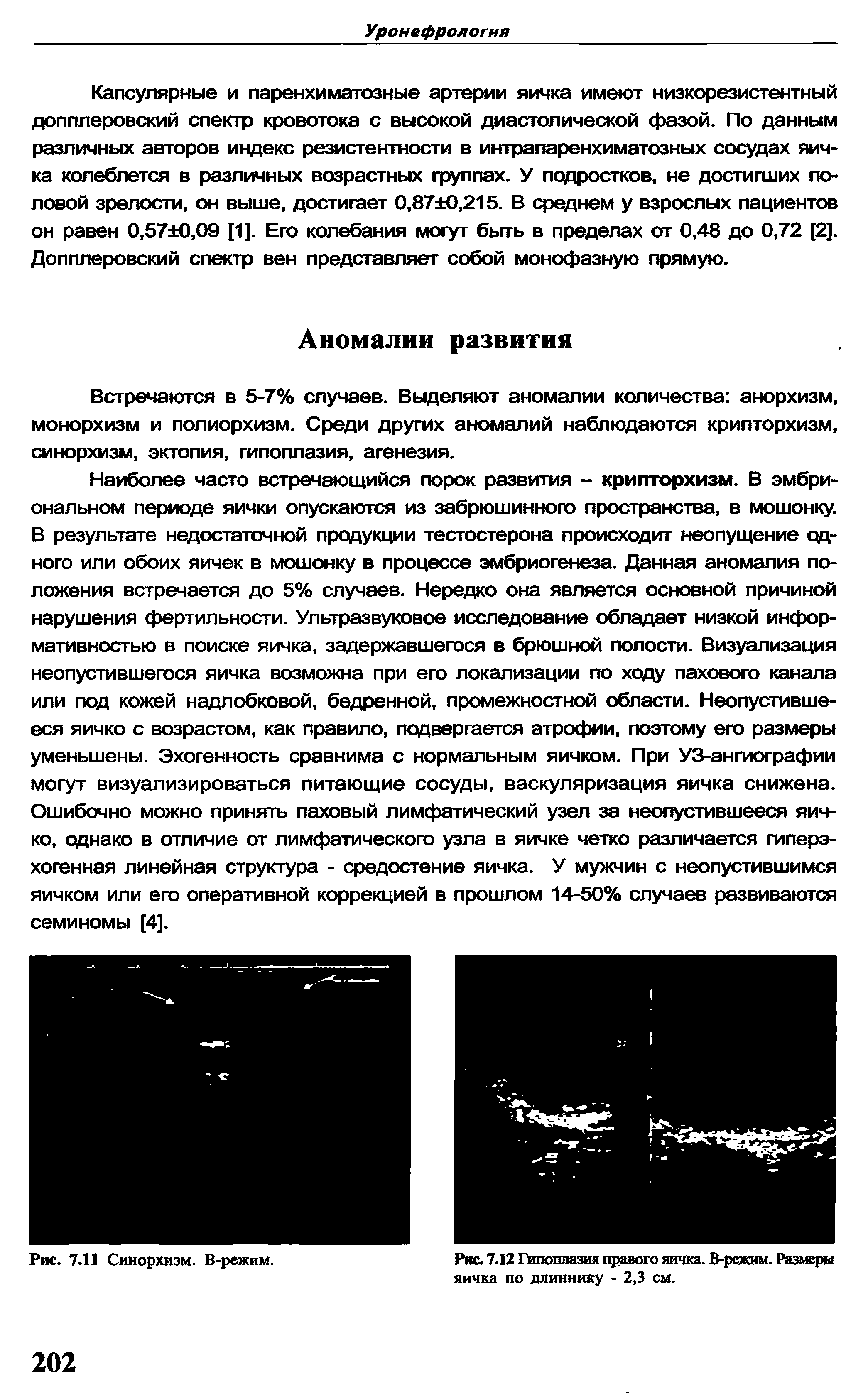 Рис. 7.12 Гипоплазия правого яичка. В-режим. Размеры яичка по длиннику - 2,3 см.