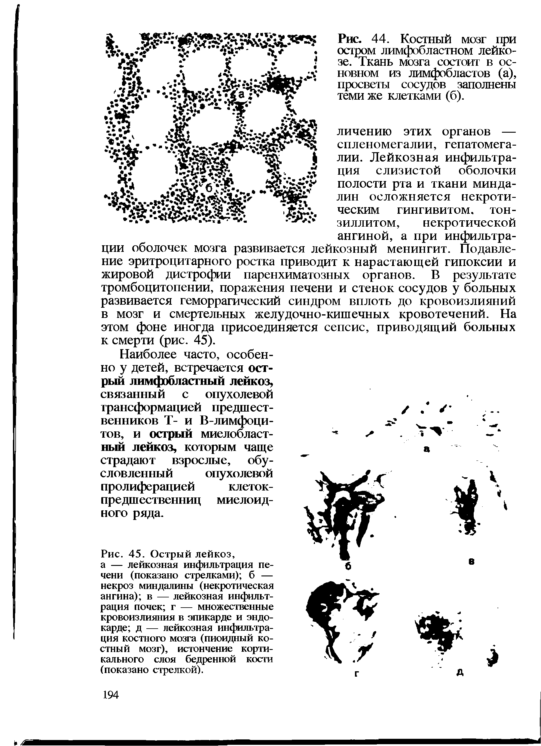 Рис. 45. Острый лейкоз, а — лейкозная инфильтрация печени (показано стрелками) б — некроз миндалины (некротическая ангина) в — лейкозная инфильтрация почек г — множественные кровоизлияния в эпикарде и эндокарде д — лейкозная инфильтрация костного мозга (пиоидный костный мозг), истончение кортикального слоя бедренной кости (показано стрелкой).