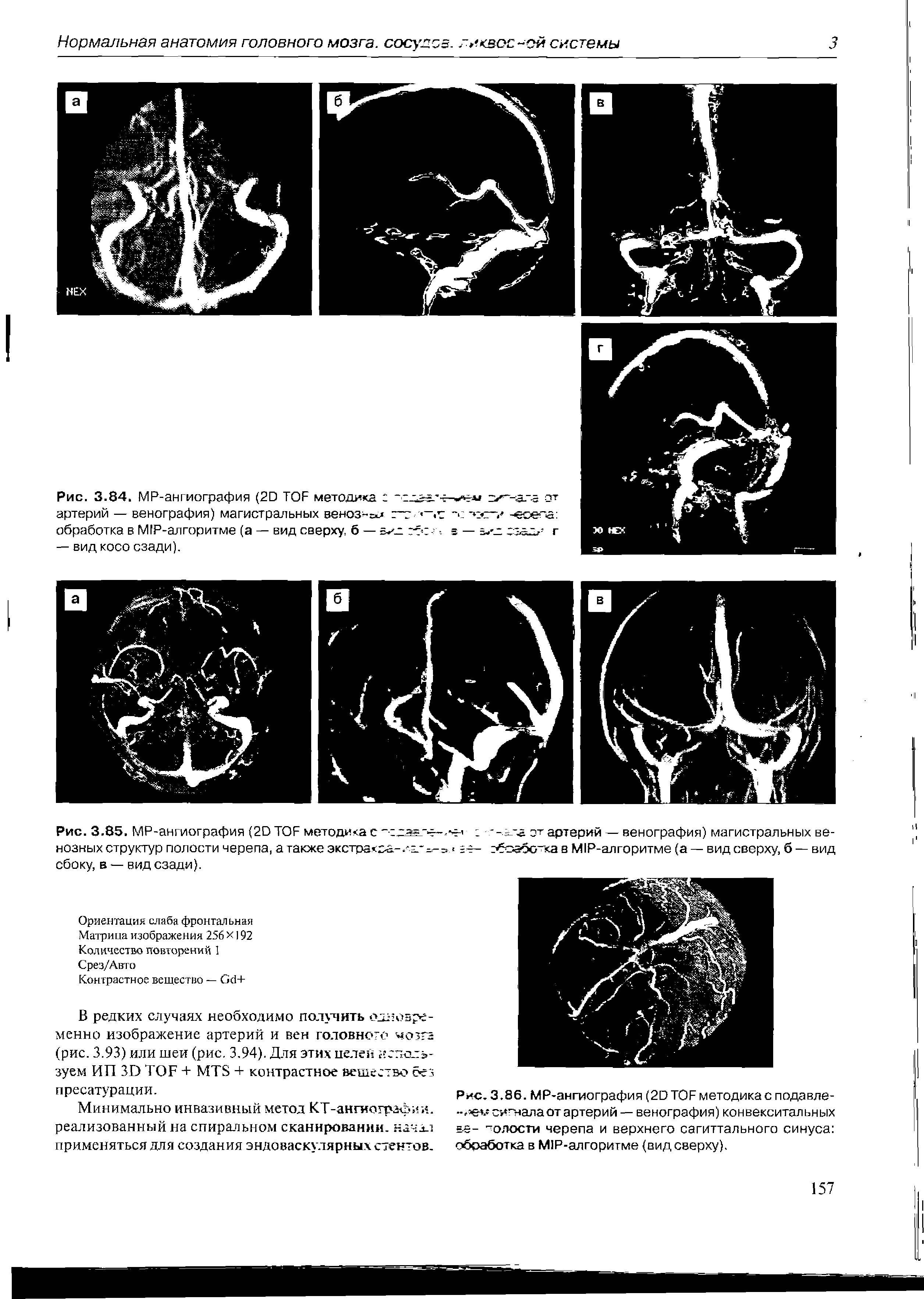 Рис. 3.86. МР-ангиография (20Т0Рметодика с подавле-сигнала от артерий — венография) конвекситальных = =- "толости черепа и верхнего сагиттального синуса обработка в М1Р-алгоритме (вид сверху).