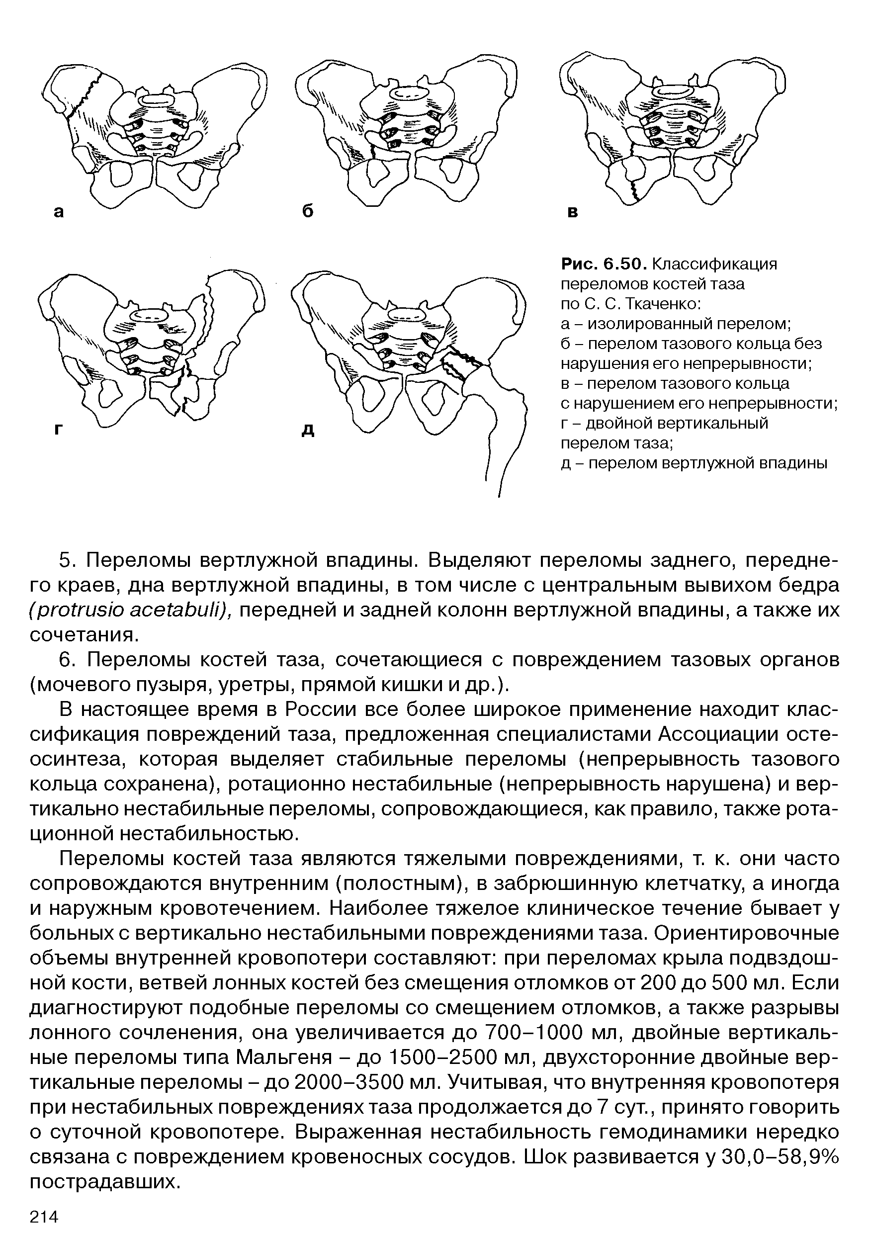 Рис. 6.50. Классификация переломов костей таза по С. С. Ткаченко а - изолированный перелом б - перелом тазового кольца без нарушения его непрерывности в - перелом тазового кольца с нарушением его непрерывности г - двойной вертикальный перелом таза ...