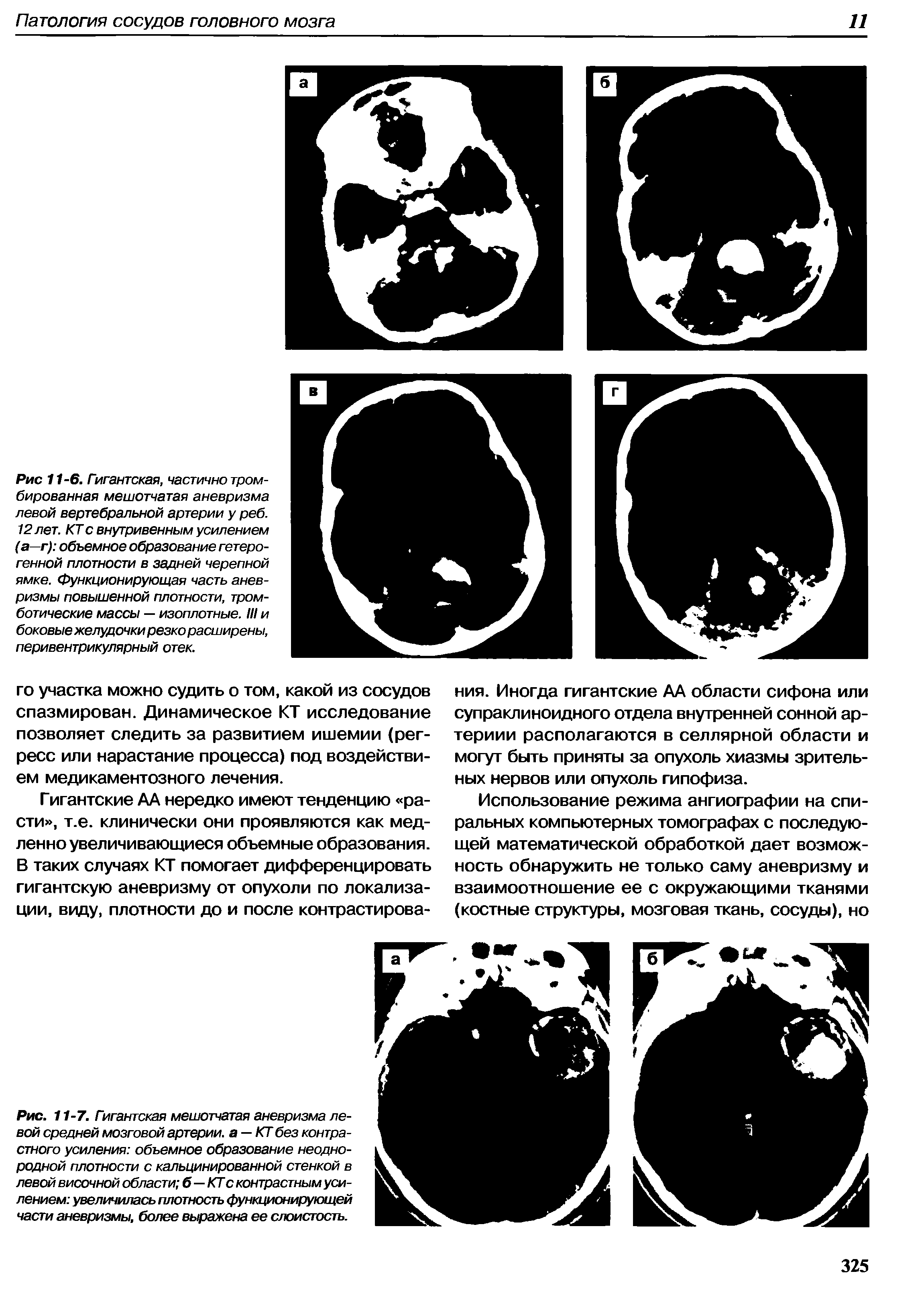 Рис. 11-7. Гигантская мешотчатая аневризма левой средней мозговой артерии, а —КТ без контрастного усиления объемное образование неоднородной плотности с кальцинированной стенкой в левой височной области б—КТ с контрастным усилением увеличилась плотность функционирующей части аневризмы, более выражена ее слоистость.