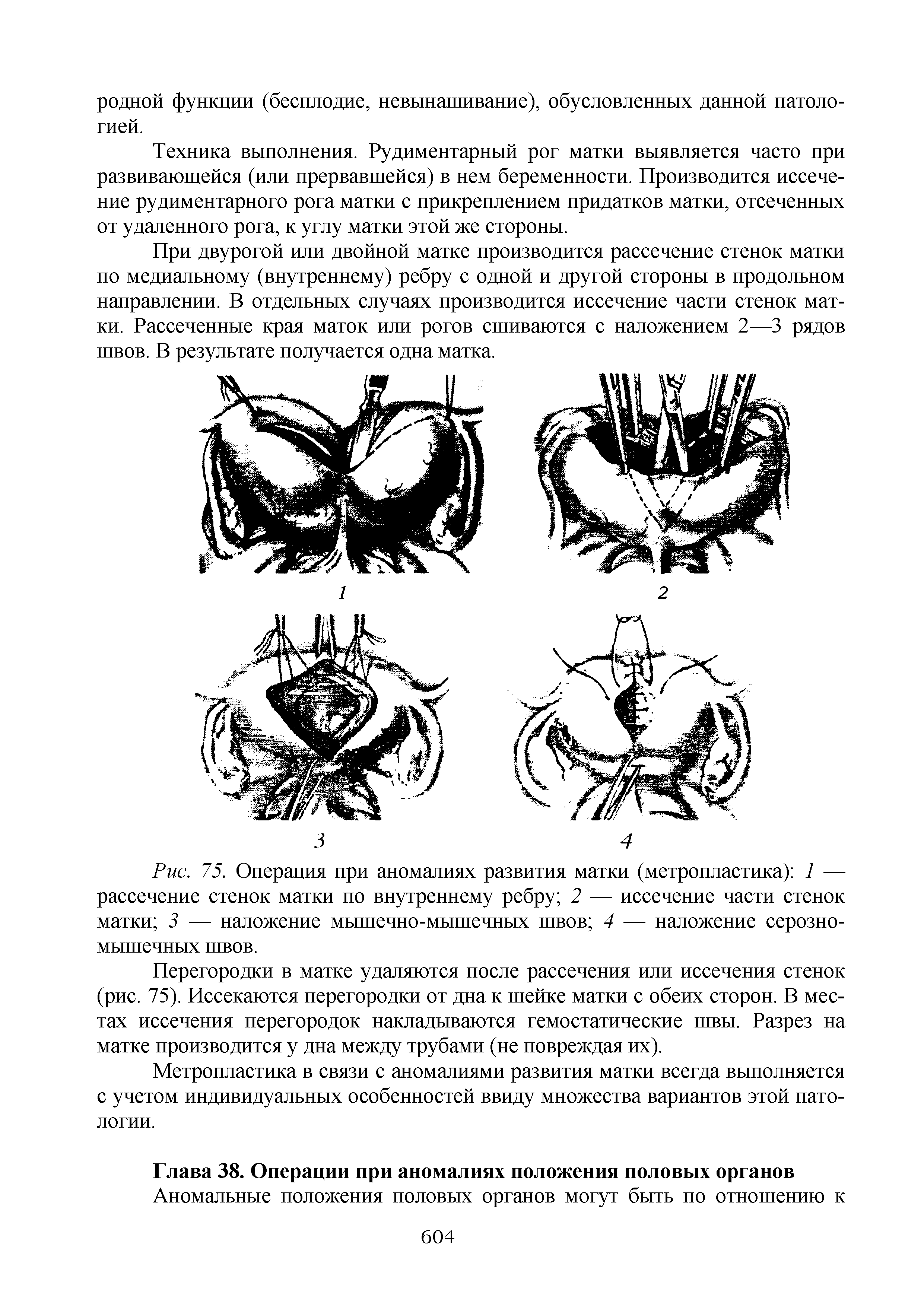 Рис. 75. Операция при аномалиях развития матки (метропластика) 1 — рассечение стенок матки по внутреннему ребру 2 — иссечение части стенок матки 3 — наложение мышечно-мышечных швов 4 — наложение серозномышечных швов.