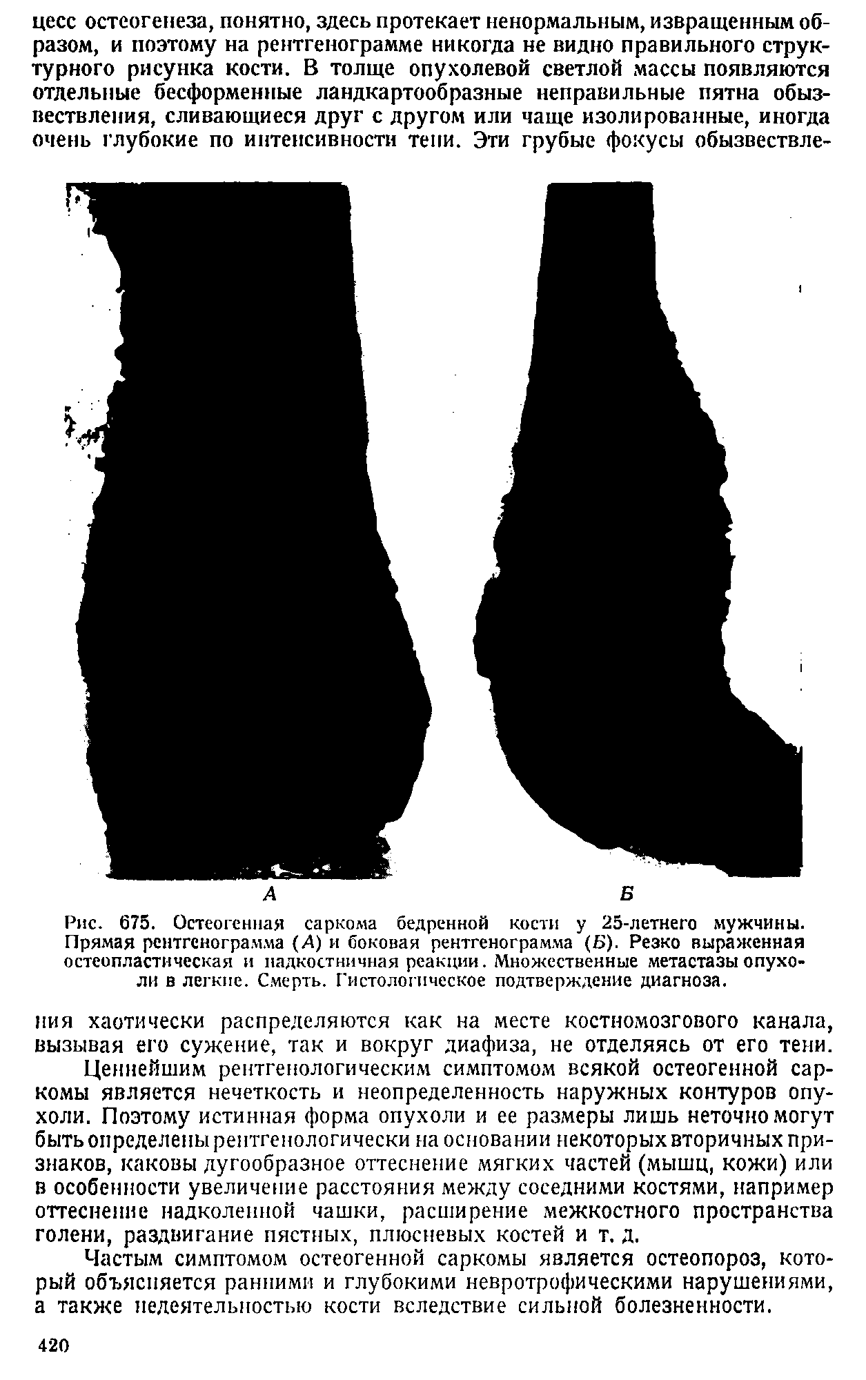 Рис. 675. Остеогенная саркома бедренной кости у 25-летнего мужчины. Прямая рентгенограмма (А) и боковая рентгенограмма (Б). Резко выраженная остеопластическая и надкостничная реакции. Множественные метастазы опухоли в легкие. Смерть. Гистологическое подтверждение диагноза.