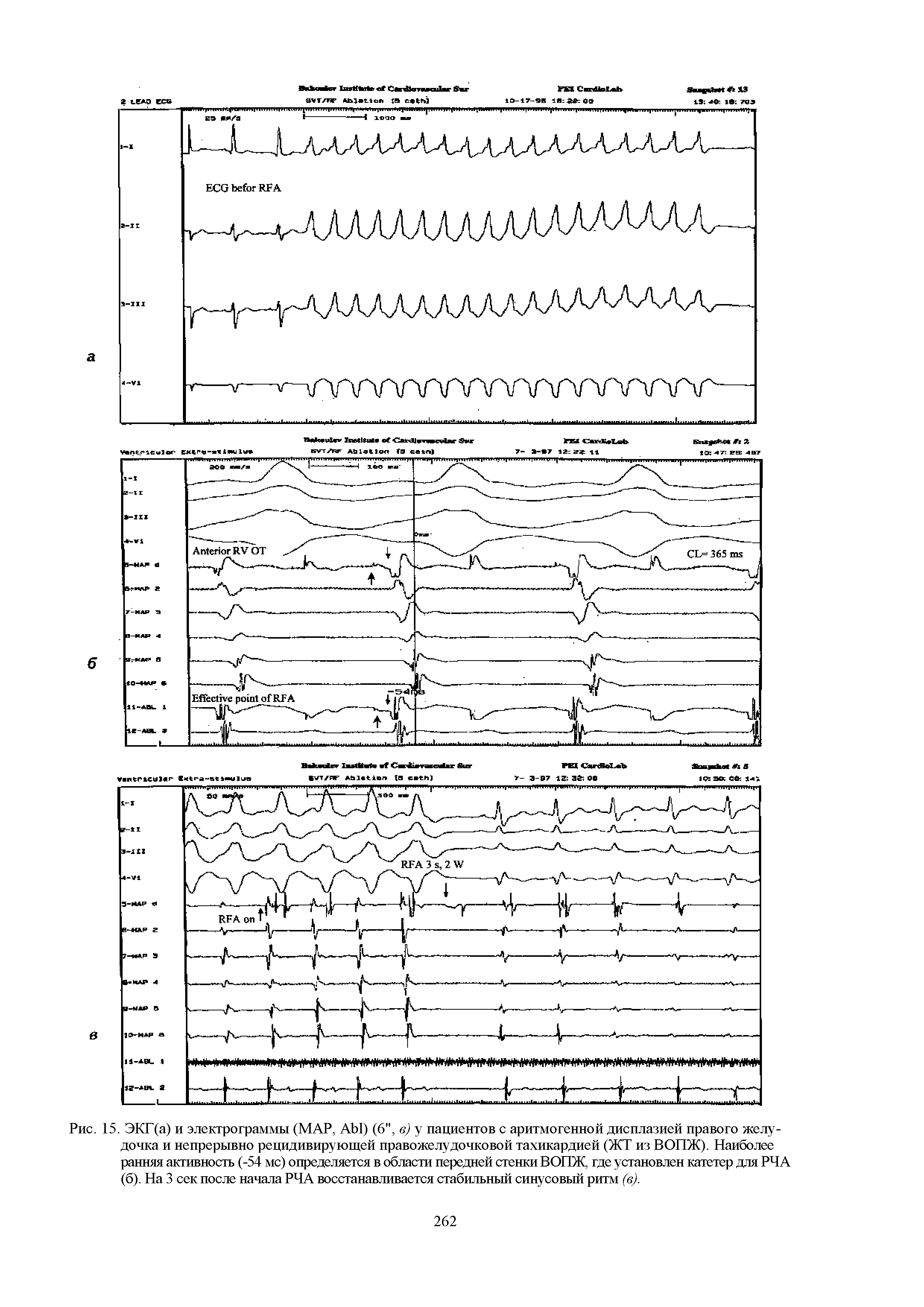 Рис. 15. ЭКГ(а) и электрограммы (MAP, A ) (6", в) у пациентов с аритмогенной дисплазией правого желудочка и непрерывно рецидивирующей правожелудочковой тахикардией (ЖТ из ВОПЖ). Наиболее ранняя активность (-54 мс) определяется в области передней стенки ВОПЖ, где установлен катетер для РЧА (б). На 3 сек после начала РЧА восстанавливается стабильный синусовый ритм (в).