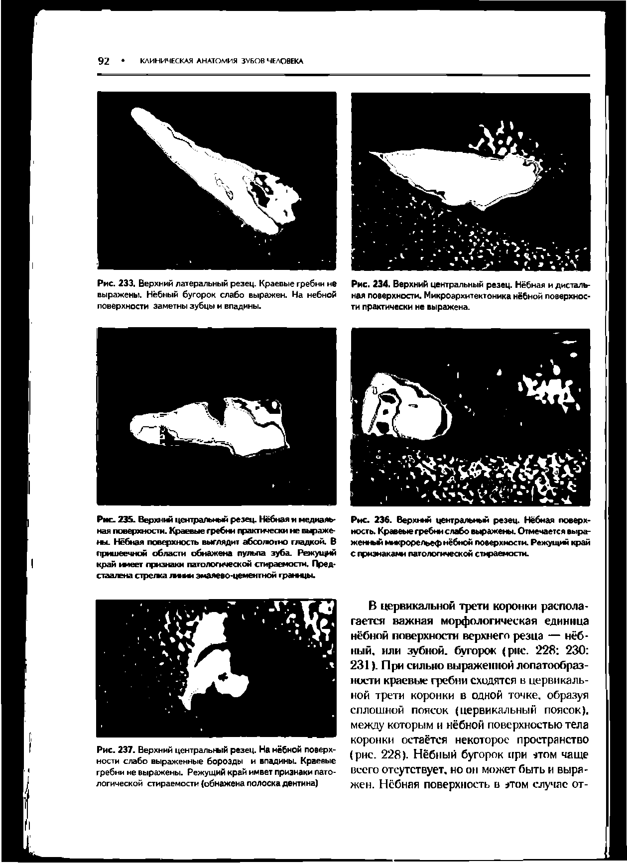 Рис. 236. Верхний центральный резец. Нёбная поверхность. Краевые гребни слабо выражены. Отмечается выраженный микрорельеф нёбной поверхности. Режущ край с признаками патологической стираемости.