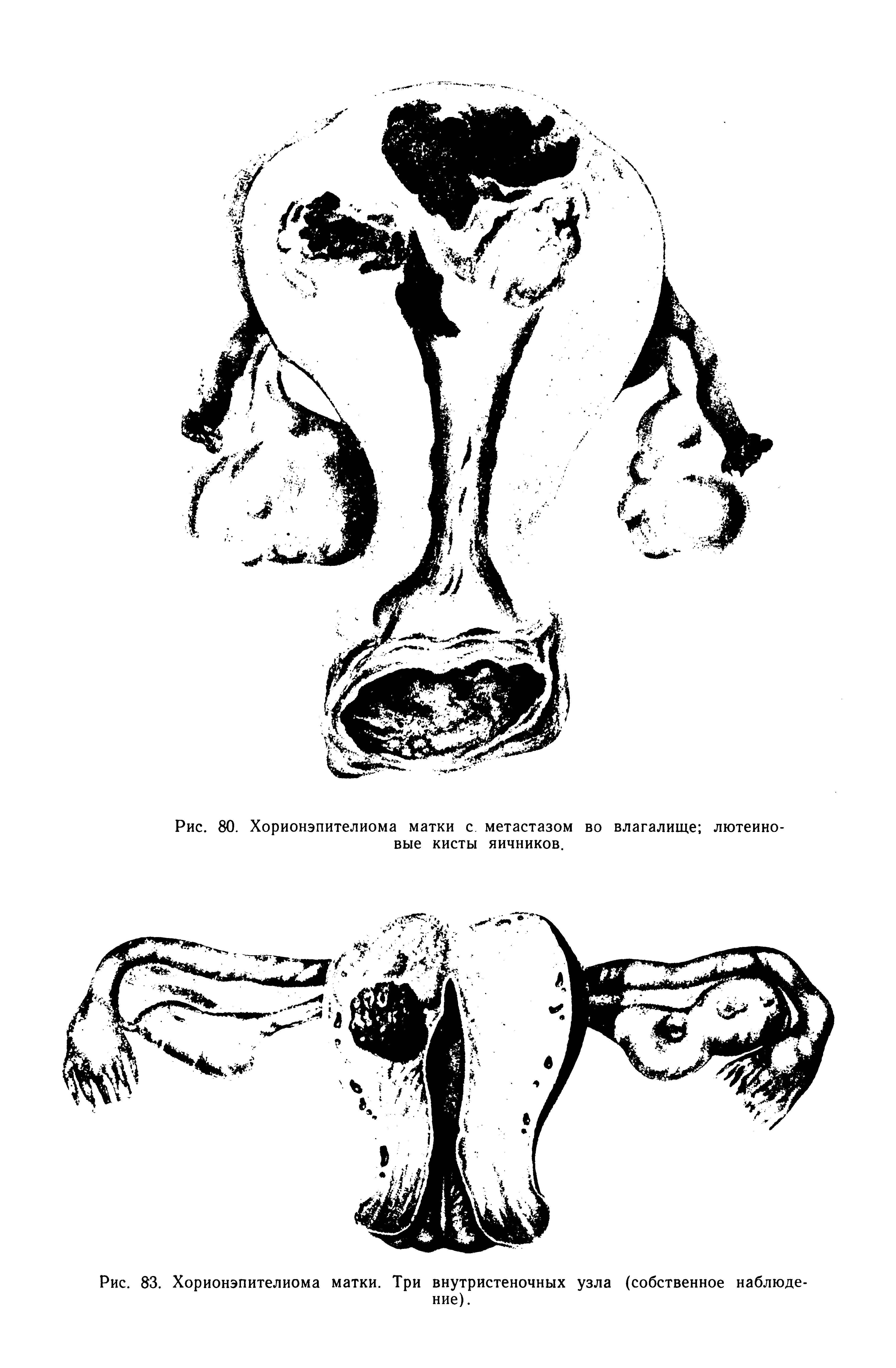 Рис. 83. Хорионэпителиома матки. Три внутристеночных узла (собственное наблюдение).