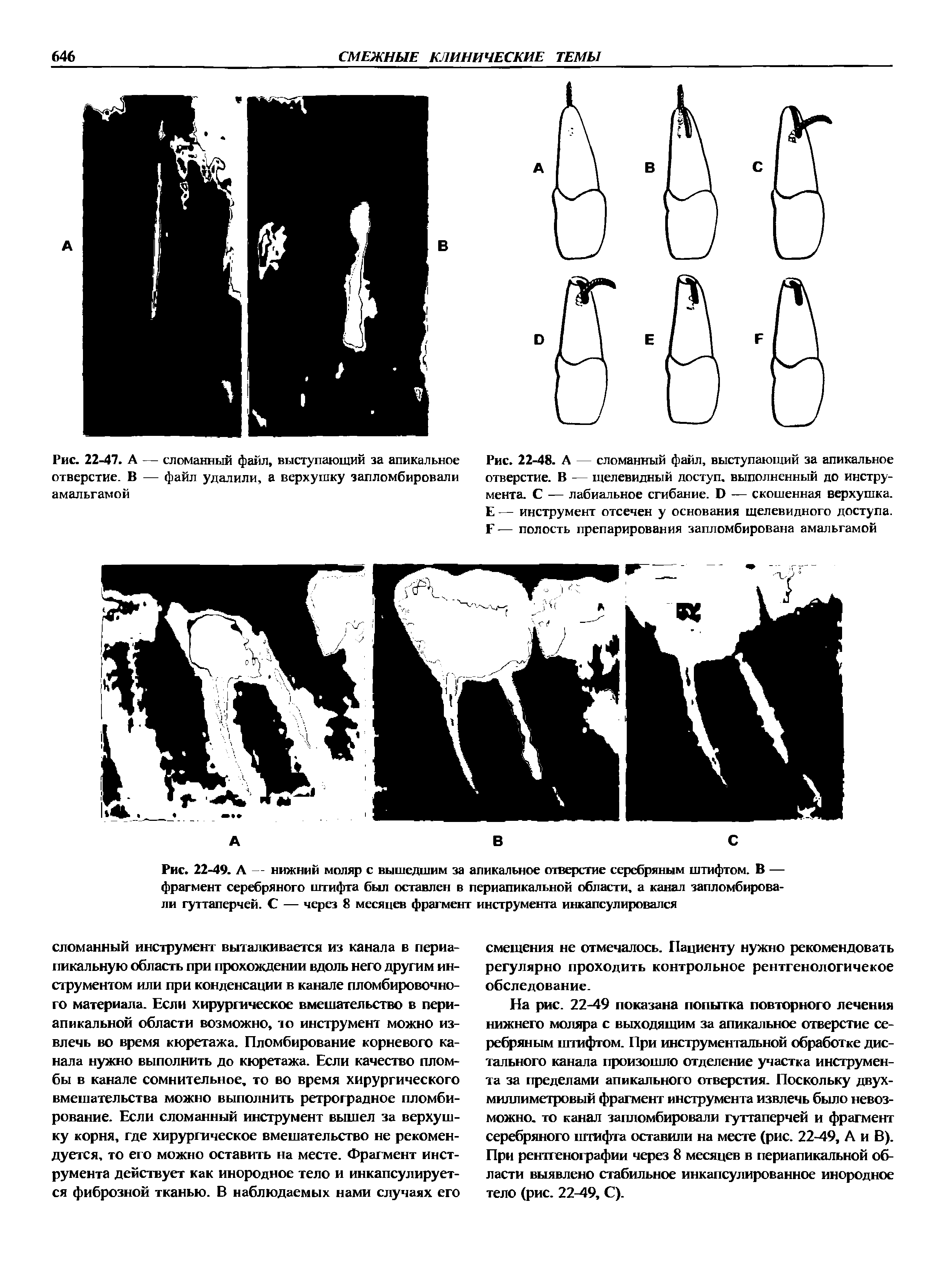 Рис. 22-48. А — сломанный файл, выступающий за апикальное отверстие. В — щелевидный доступ, выполненный до инструмента. С — лабиальное сгибание. Б — скошенная верхушка. Е — инструмент отсечен у основания щелевидного доступа. Г — полость препарирования запломбирована амальгамой...