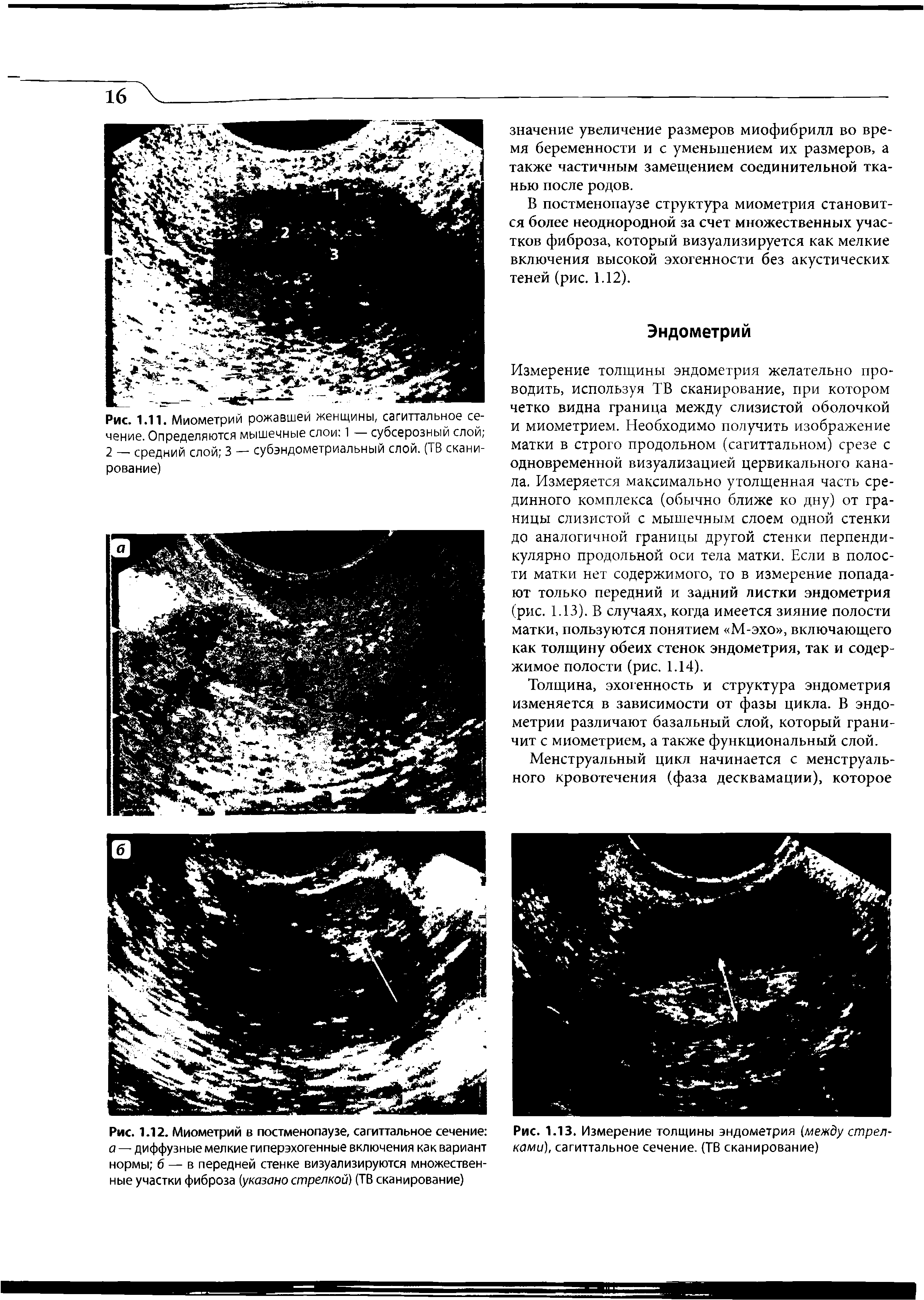 Рис. 1.13. Измерение толщины эндометрия (между стрел ками, сагиттальное сечение. (ТВ сканирование)...