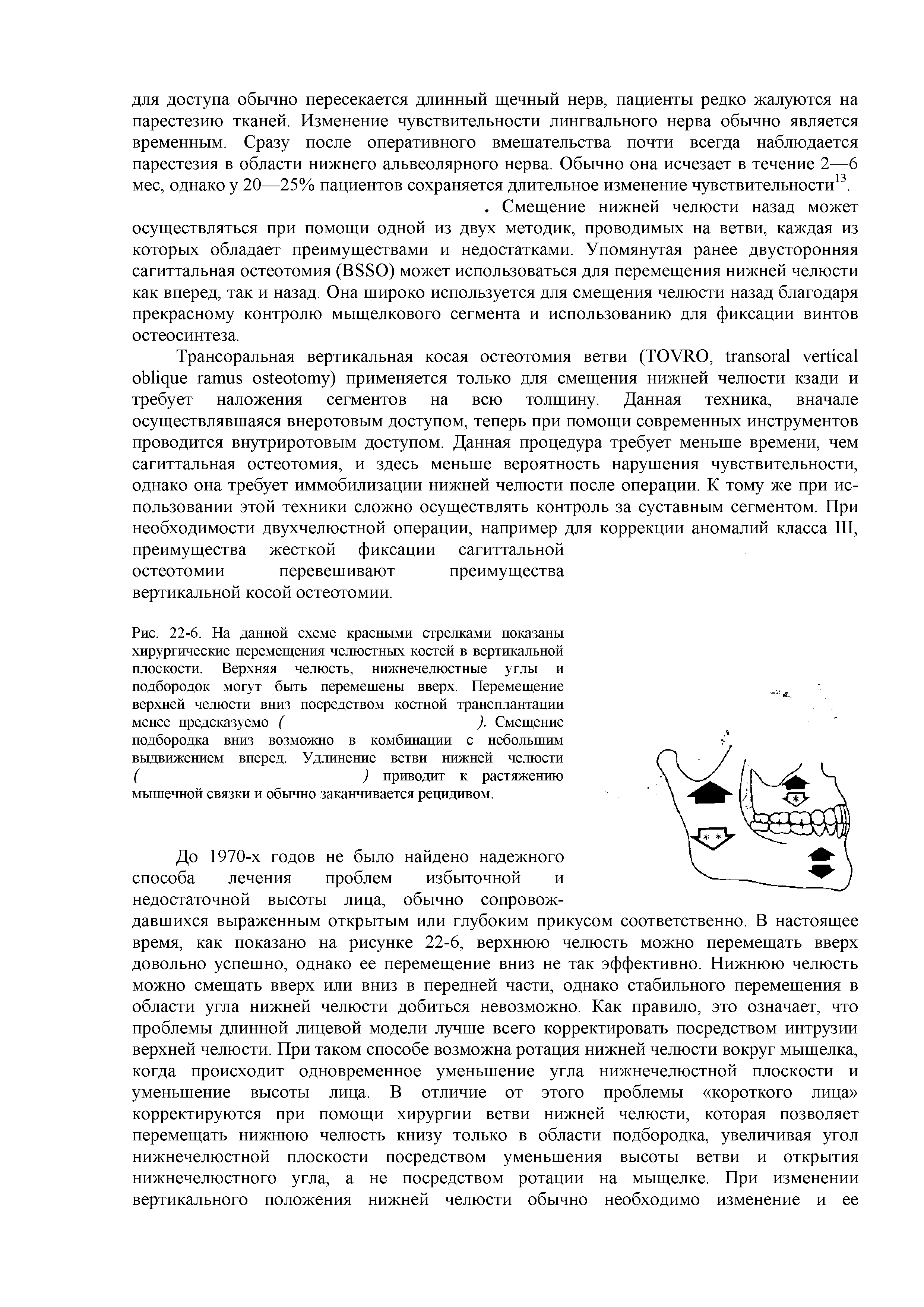 Рис. 22-6. На данной схеме красными стрелками показаны хирургические перемещения челюстных костей в вертикальной плоскости. Верхняя челюсть, нижнечелюстные углы и подбородок могут быть перемешены вверх. Перемещение верхней челюсти вниз посредством костной трансплантации менее предсказуемо ( ). Смещение...
