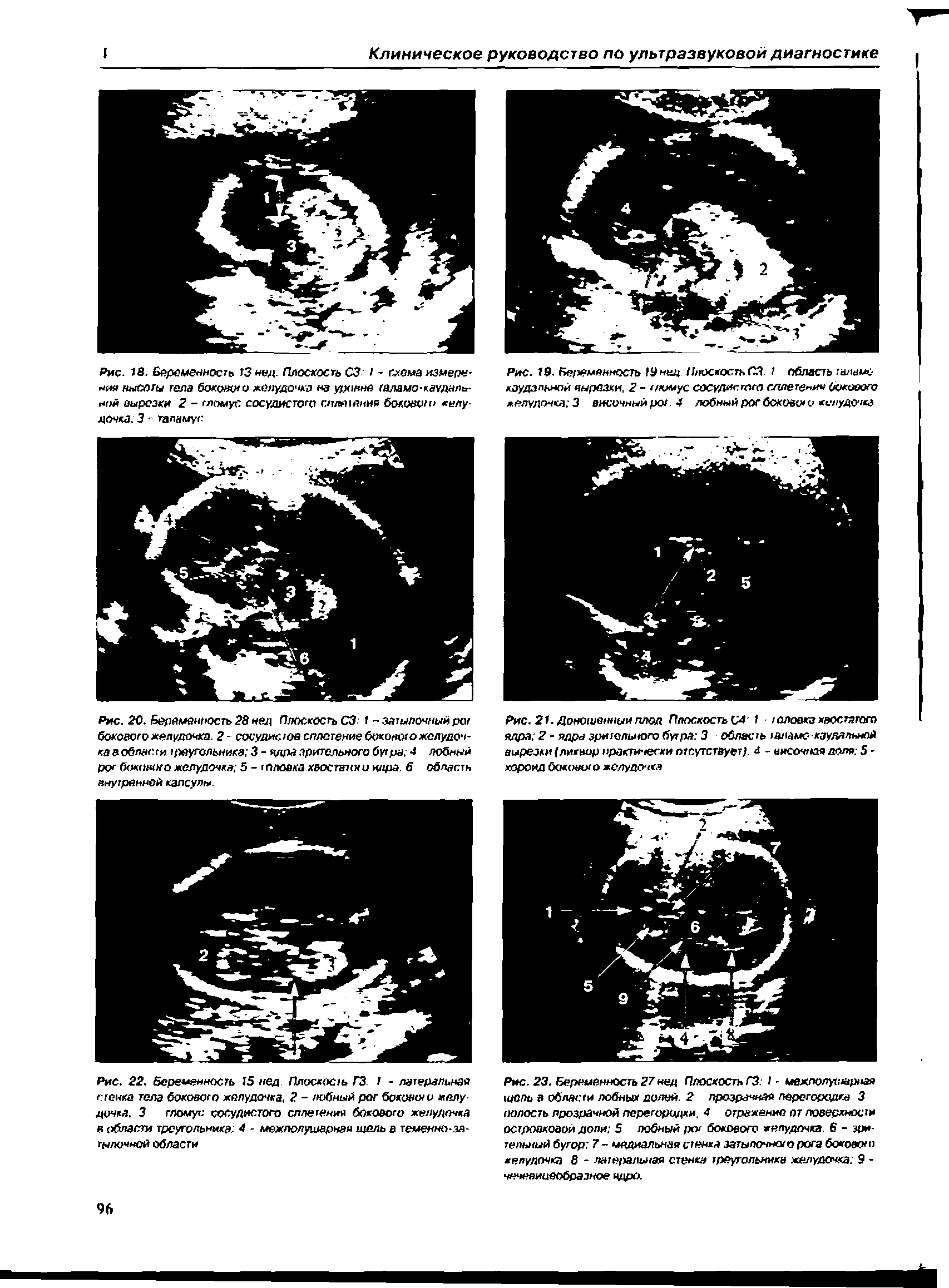 Рис. 23. Беременность 27 нед Плоскость ГЗ / - межполушарная щель в области лобных долей. 2 прозрачная перегородка 3 полость прозрачной перегородки 4 отражение пт поверхности островковой доли 5 лобный /хх бокового желудочка. 6 - зрительный бугор 7 - медиальная стенка затылочного рога боковою желудочка 8 - латеральная стенка треугольника желудочка 9 -чечевицеобразное ядро.