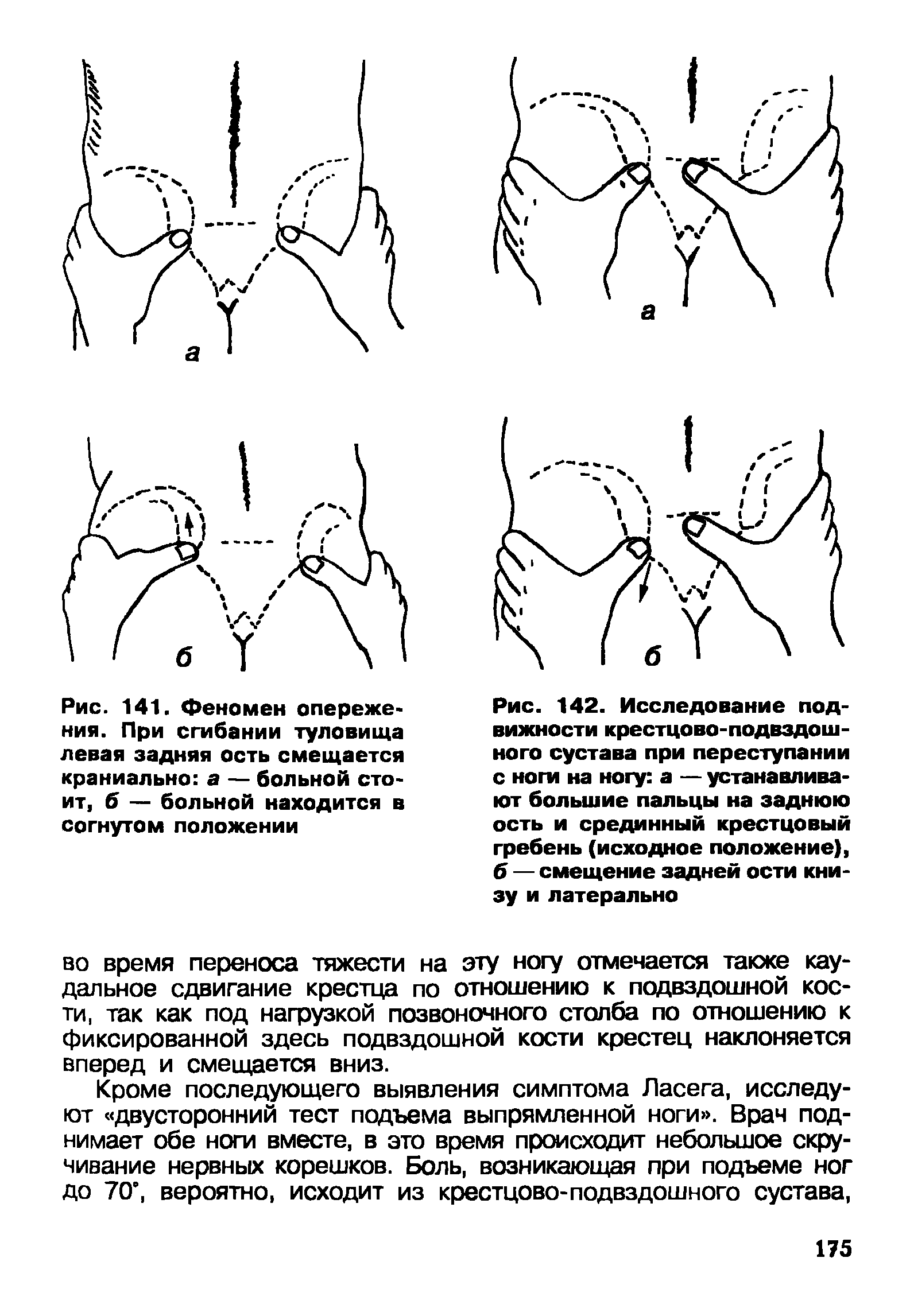 Рис. 142. Исследование подвижности крестцово-подвздошного сустава при переступании с ноги на ногу а — устанавливают большие пальцы на заднюю ость и срединный крестцовый гребень (исходное положение), б — смещение задней ости книзу и латерально...