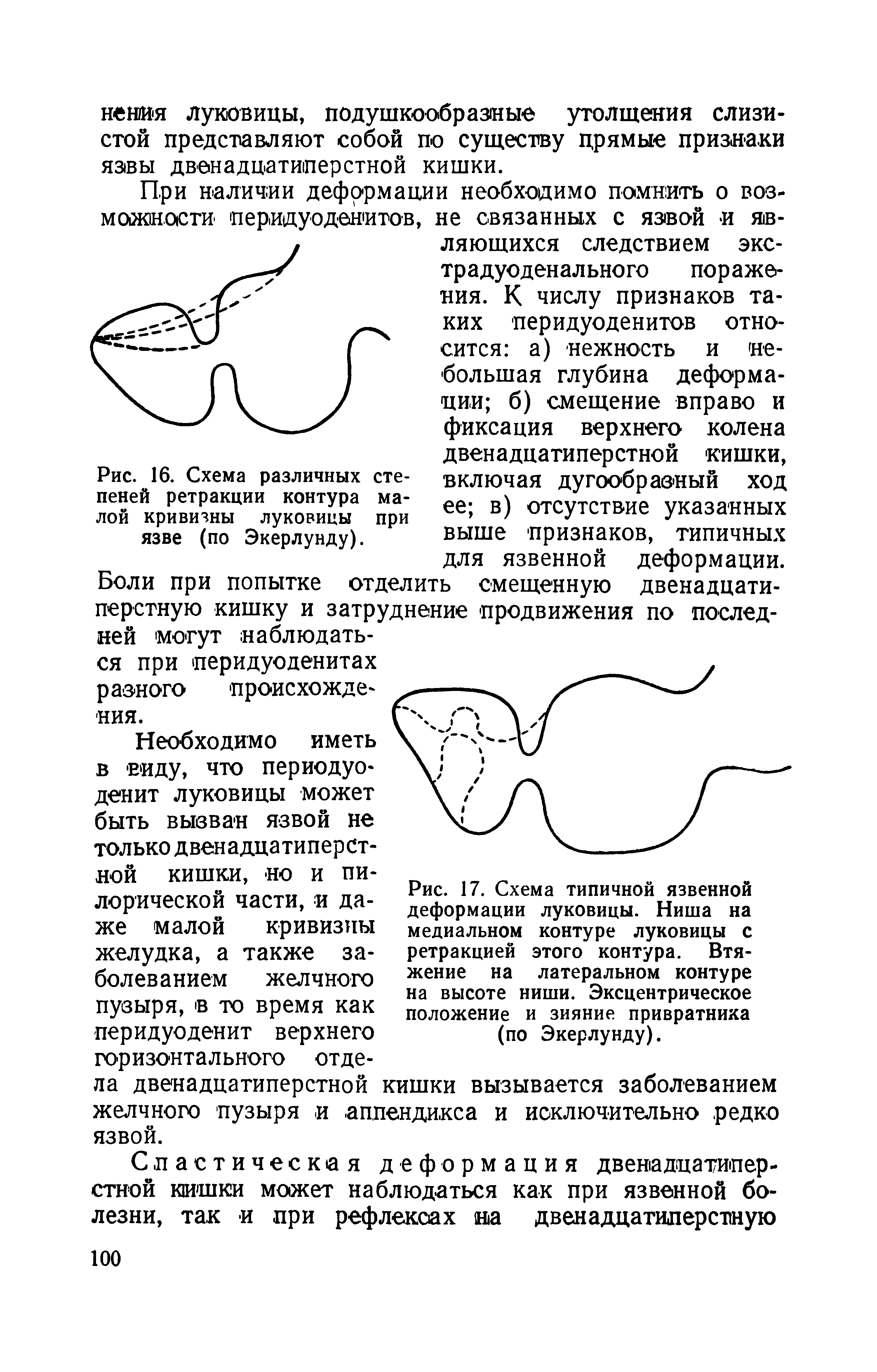 Рис. 17. Схема типичной язвенной деформации луковицы. Ниша на медиальном контуре луковицы с ретракцией этого контура. Втяжение на латеральном контуре на высоте ниши. Эксцентрическое положение и зияние привратника (по Экерлунду).