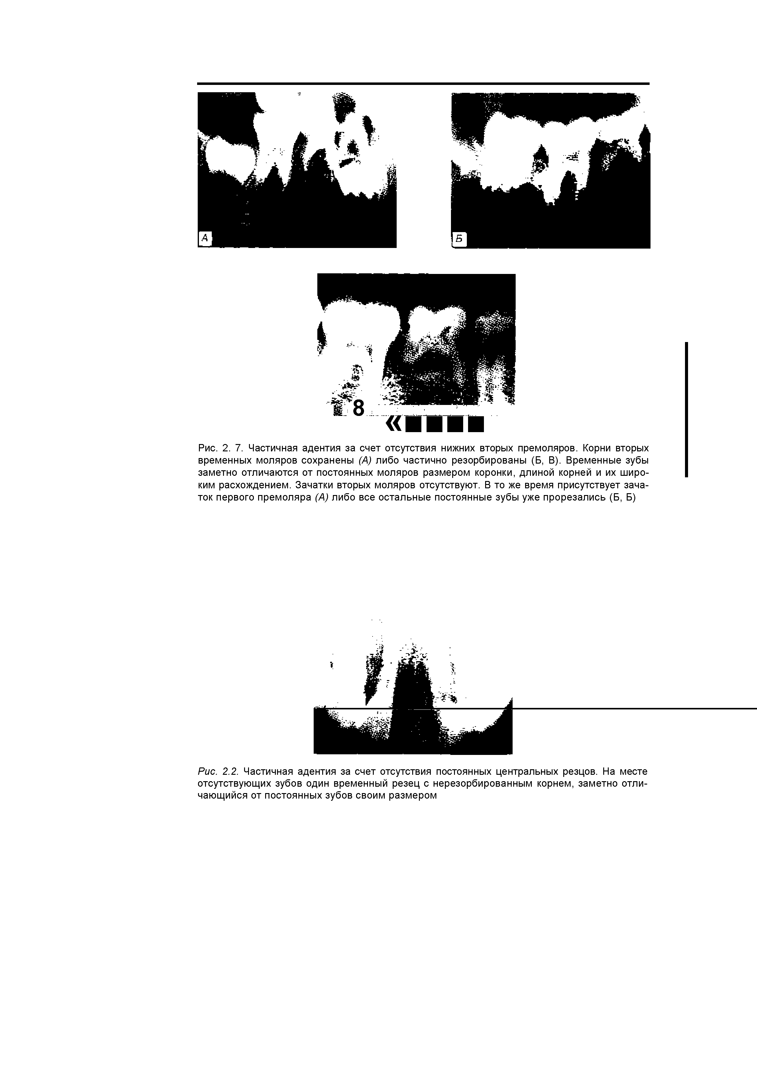 Рис. 2.2. Частичная адентия за счет отсутствия постоянных центральных резцов. На месте отсутствующих зубов один временный резец с нерезорбированным корнем, заметно отличающийся от постоянных зубов своим размером...