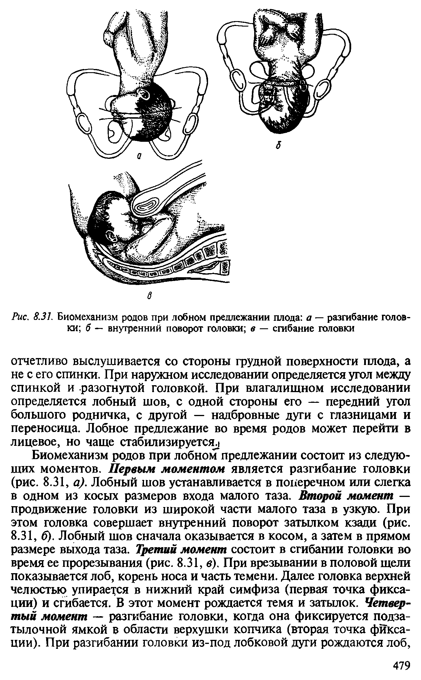 Рис. 8.31. Биомеханизм родов при лобном предлежании плода а — разгибание головки б — внутренний поворот головки в — сгибание головки...