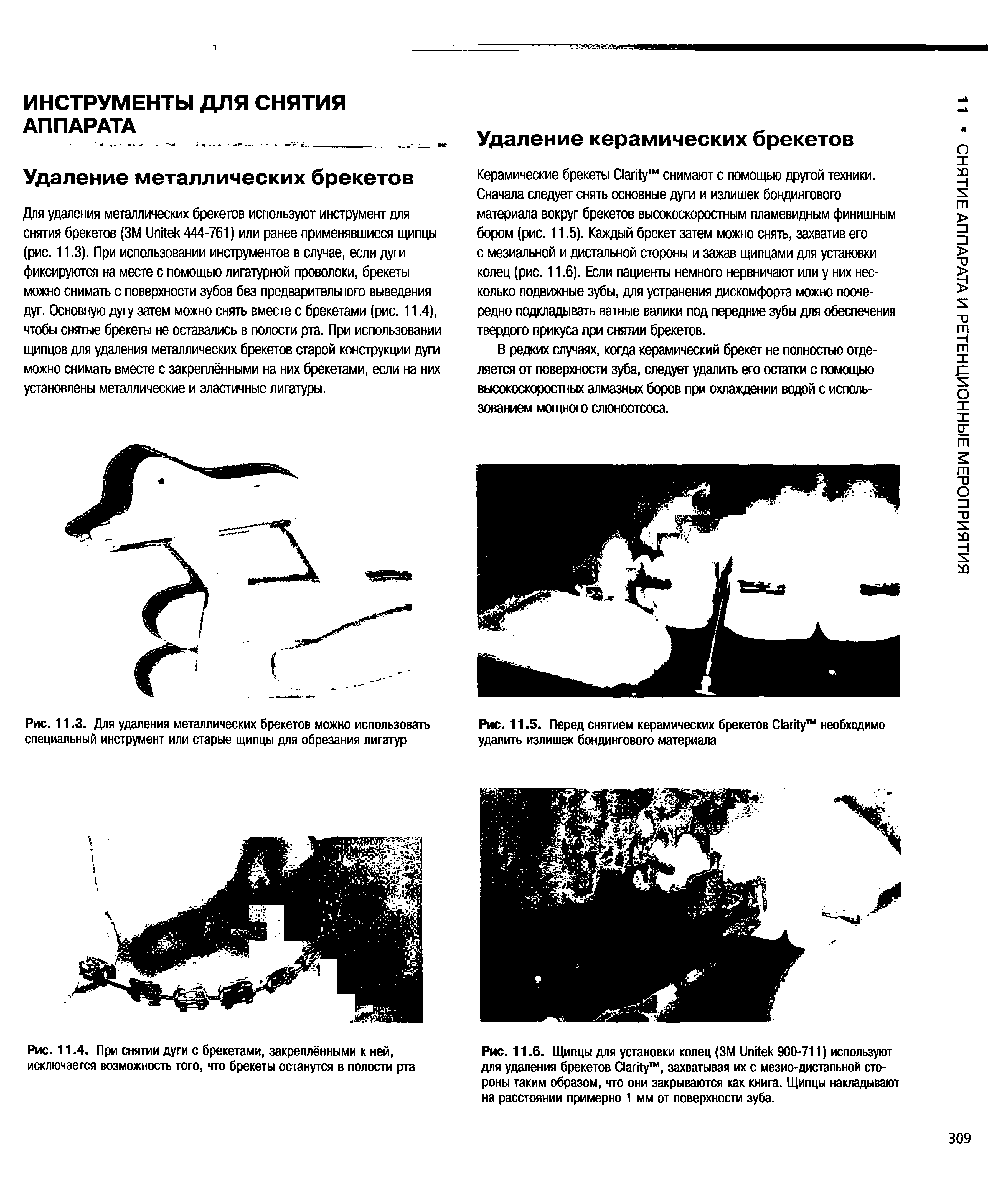 Рис. 11.4. При снятии дуги с брекетами, закреплёнными к ней, исключается возможность того, что брекеты останутся в полости рта...