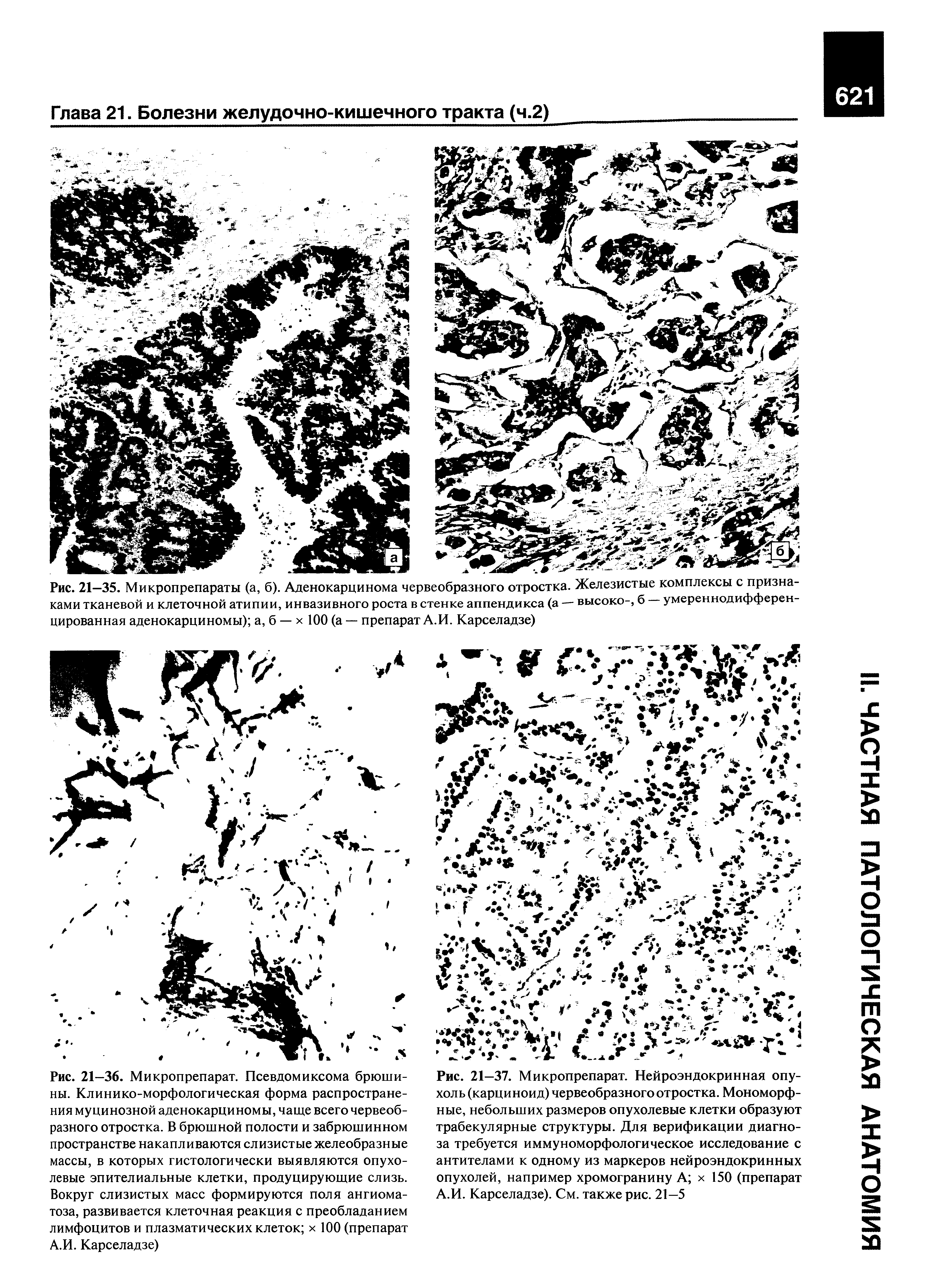 Рис. 21—35. Микропрепараты (а, б). Аденокарцинома червеобразного отростка. Железистые комплексы с признаками тканевой и клеточной атипии, инвазивного роста в стенке аппендикса (а — высоко-, б — умереннодифференцированная аденокарциномы) а, б — х 100 (а — препарат А.И. Карселадзе)...