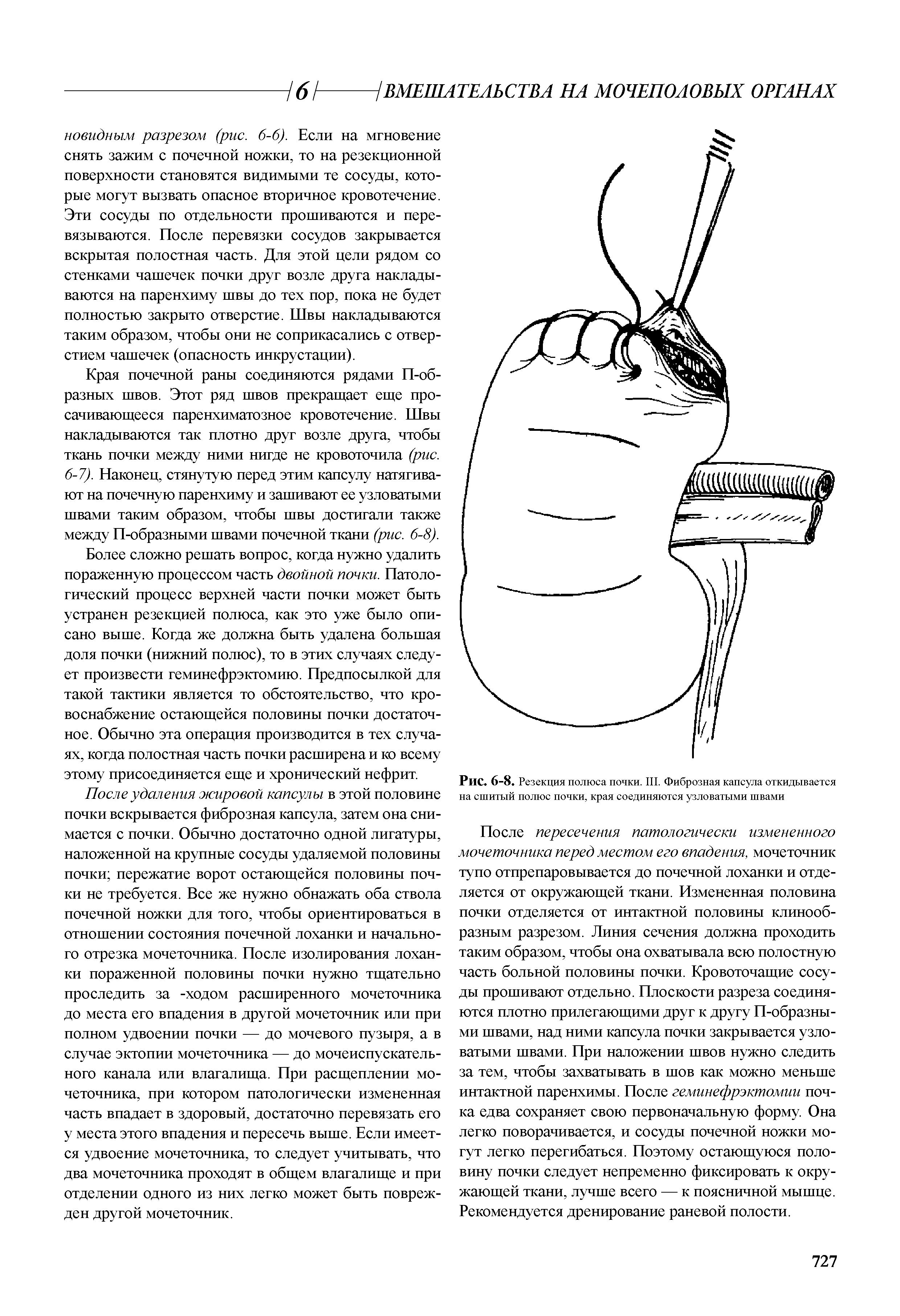 Рис. 6-8. Резекция полюса почки. III. Фиброзная капсула откидывается на сшитый полюс почки, края соединяются узловатыми швами...