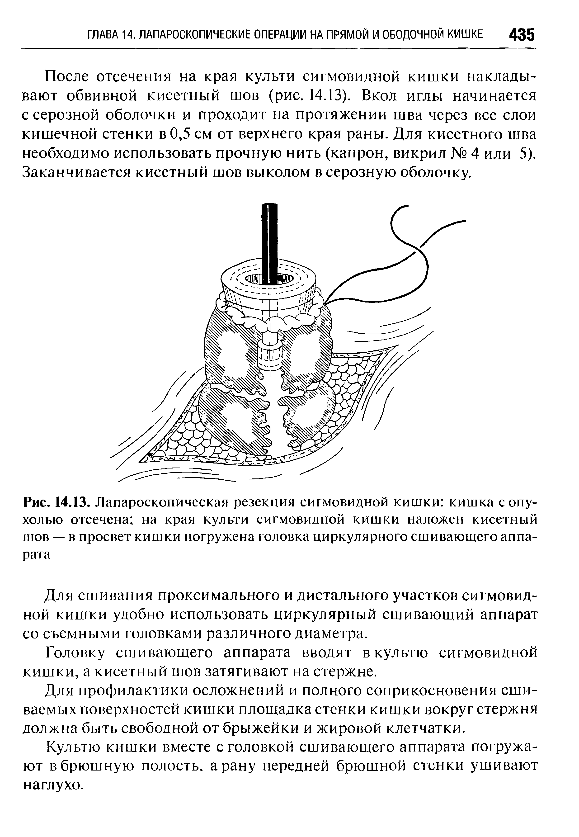 Рис. 14.13. Лапароскопическая резекция сигмовидной кишки кишка с опухолью отсечена на края культи сигмовидной кишки наложен кисетный шов — в просвет кишки погружена головка циркулярного сшивающего аппарата...