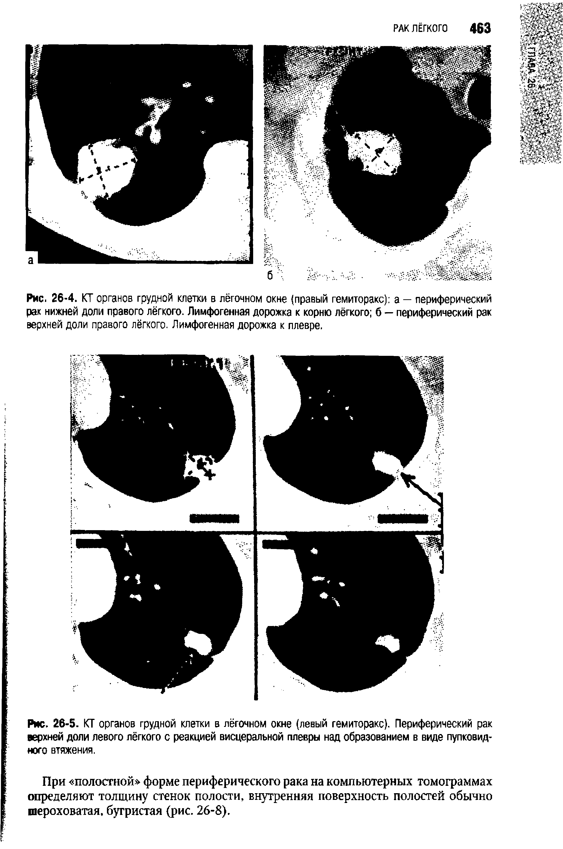 Рис. 26-4. КТ органов грудной клетки в лёгочном окне (правый гемиторакс) а — периферический рак нижней доли правого лёгкого. Лимфогенная дорожка к корню лёгкого б — периферический рак верхней доли правого лёгкого. Лимфогенная дорожка к плевре.