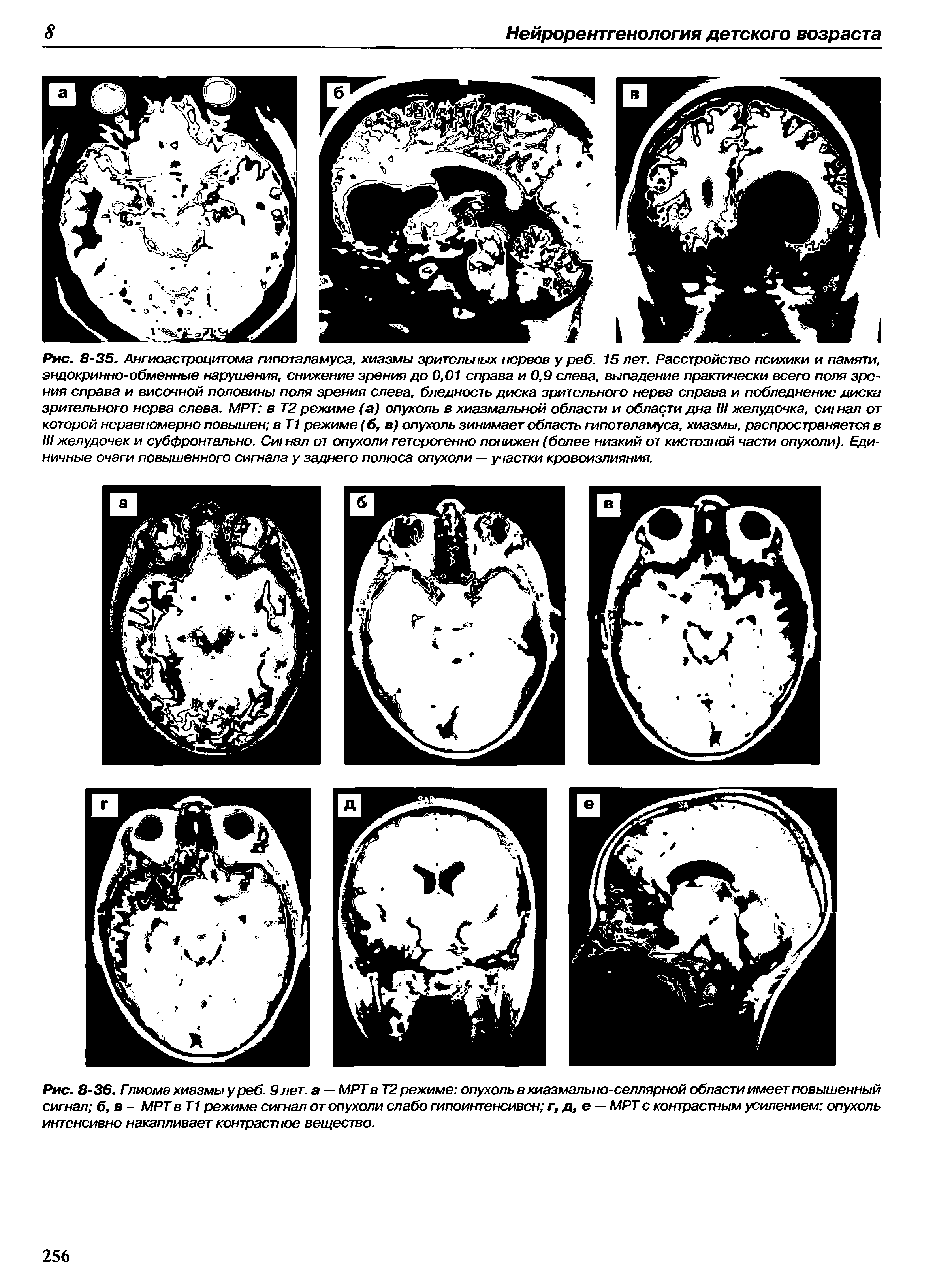 Рис. 8-36. Гпиома хиазмы у реб. 9 лет. а — МРТ в Т2 режиме опухоль в хиазмально-селлярной области имеет повышенный сигнал б, в — МРТ вТ1 режиме сигнал от опухоли слабо гипоинтенсивен г, д,е — МРТ с контрастным усилением опухоль интенсивно накапливает контрастное вещество.