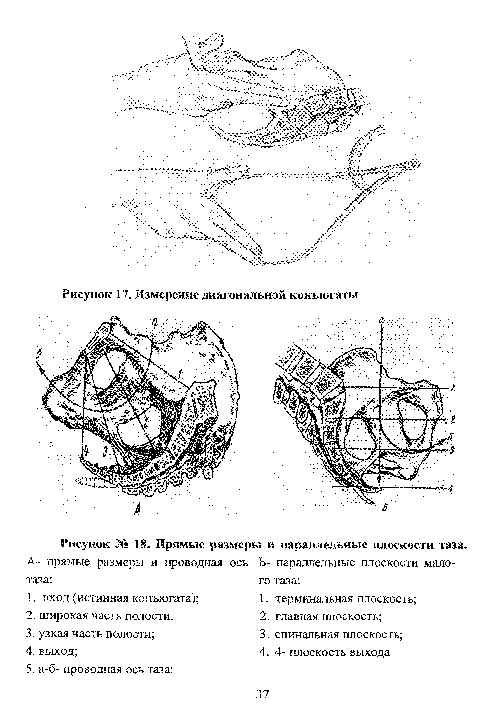 Рисунок № 18. Прямые размеры и параллельные плоскости таза. А- прямые размеры и проводная ось Б- параллельные плоскости мало-таза го таза ...