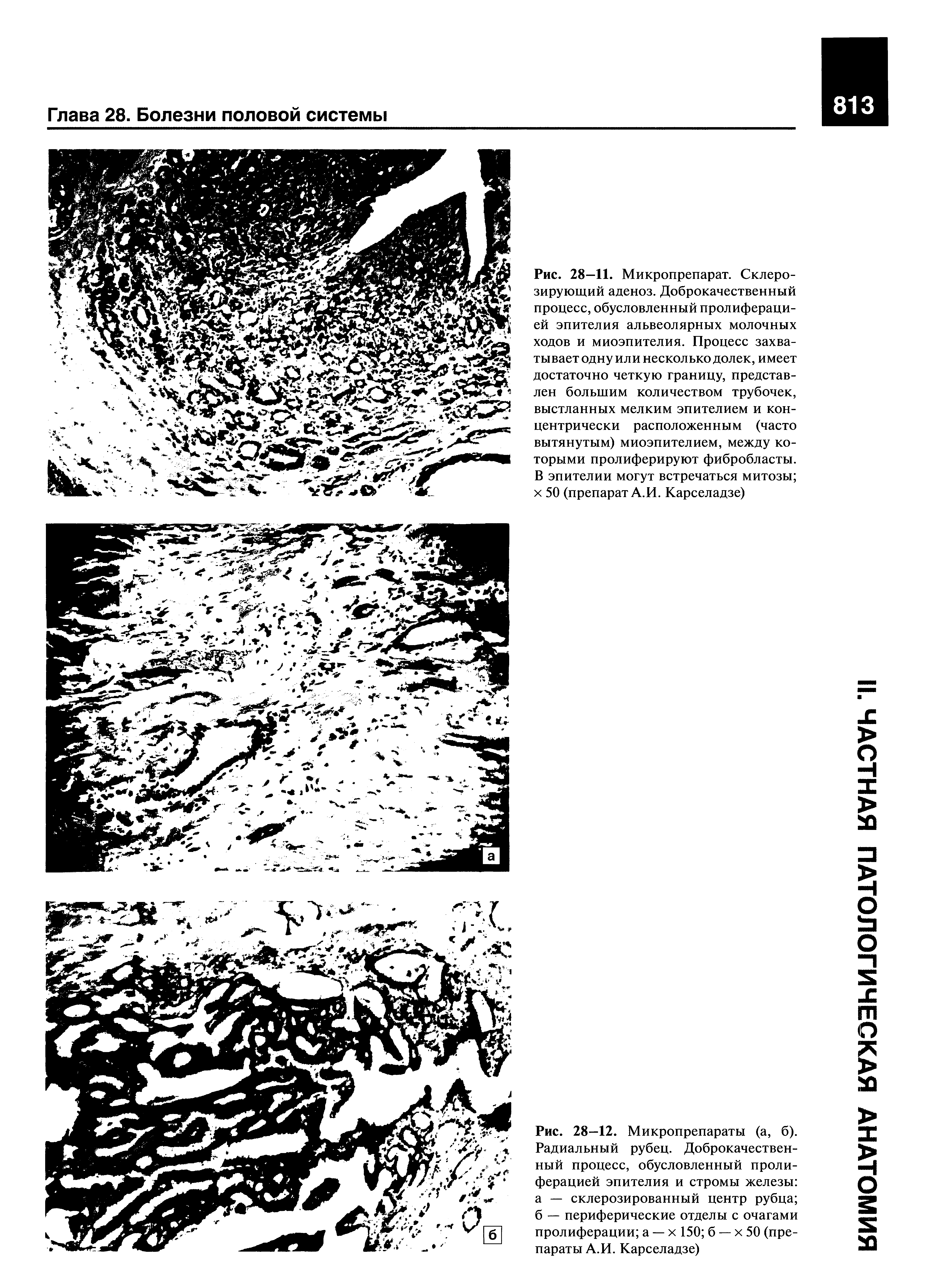 Рис. 28—12. Микропрепараты (а, б). Радиальный рубец. Доброкачественный процесс, обусловленный пролиферацией эпителия и стромы железы а — склерозированный центр рубца б — периферические отделы с очагами пролиферации а — х 150 б — х 50 (препараты А.И. Карселадзе)...