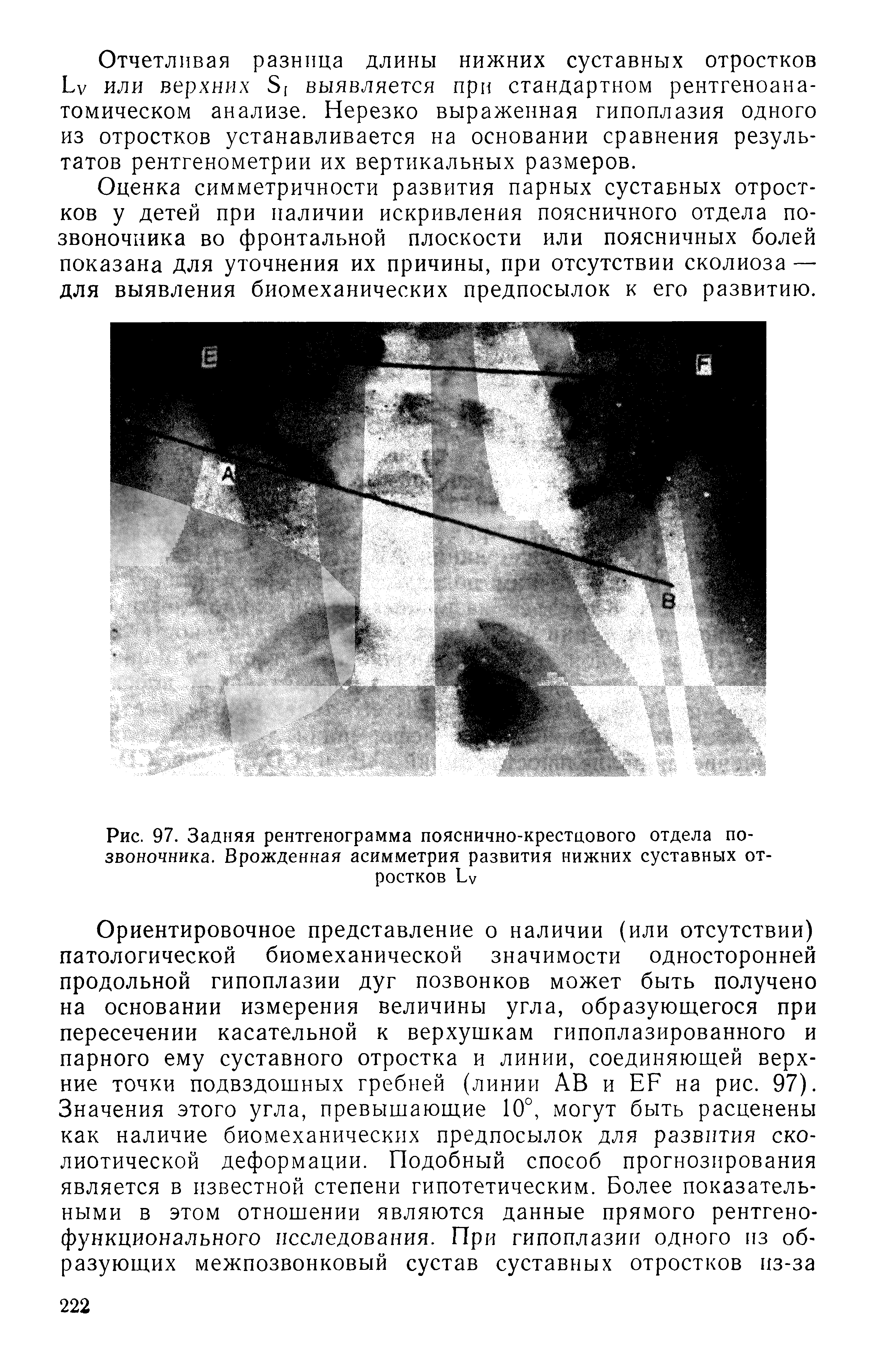 Рис. 97. Задняя рентгенограмма пояснично-крестцового отдела позвоночника. Врожденная асимметрия развития нижних суставных отростков Бу...