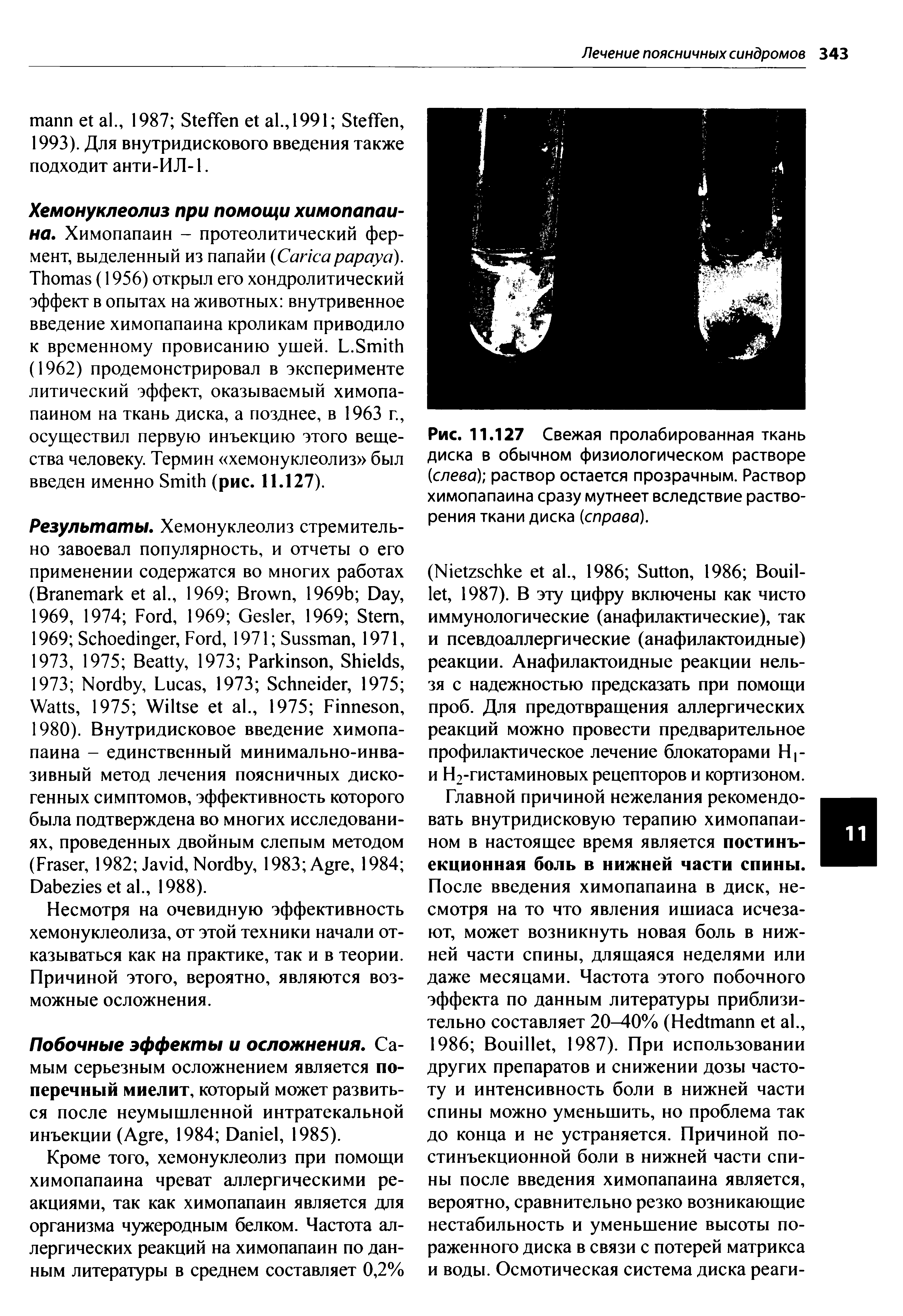 Рис. 11.127 Свежая пролабированная ткань диска в обычном физиологическом растворе (слева) раствор остается прозрачным. Раствор химопапаина сразу мутнеет вследствие растворения ткани диска (справа).