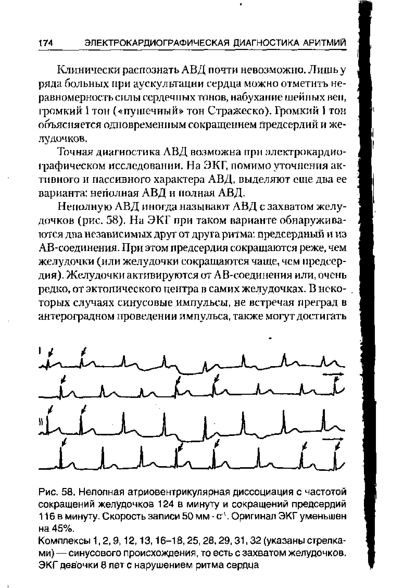 Рис. 58. Неполная атриовентрикулярная диссоциация с частотой сокращений желудочков 124 в минуту и сокращений предсердий 116 в минуту. Скорость записи 50 мм - ст. Оригинал ЭКГ уменьшен на 45%.