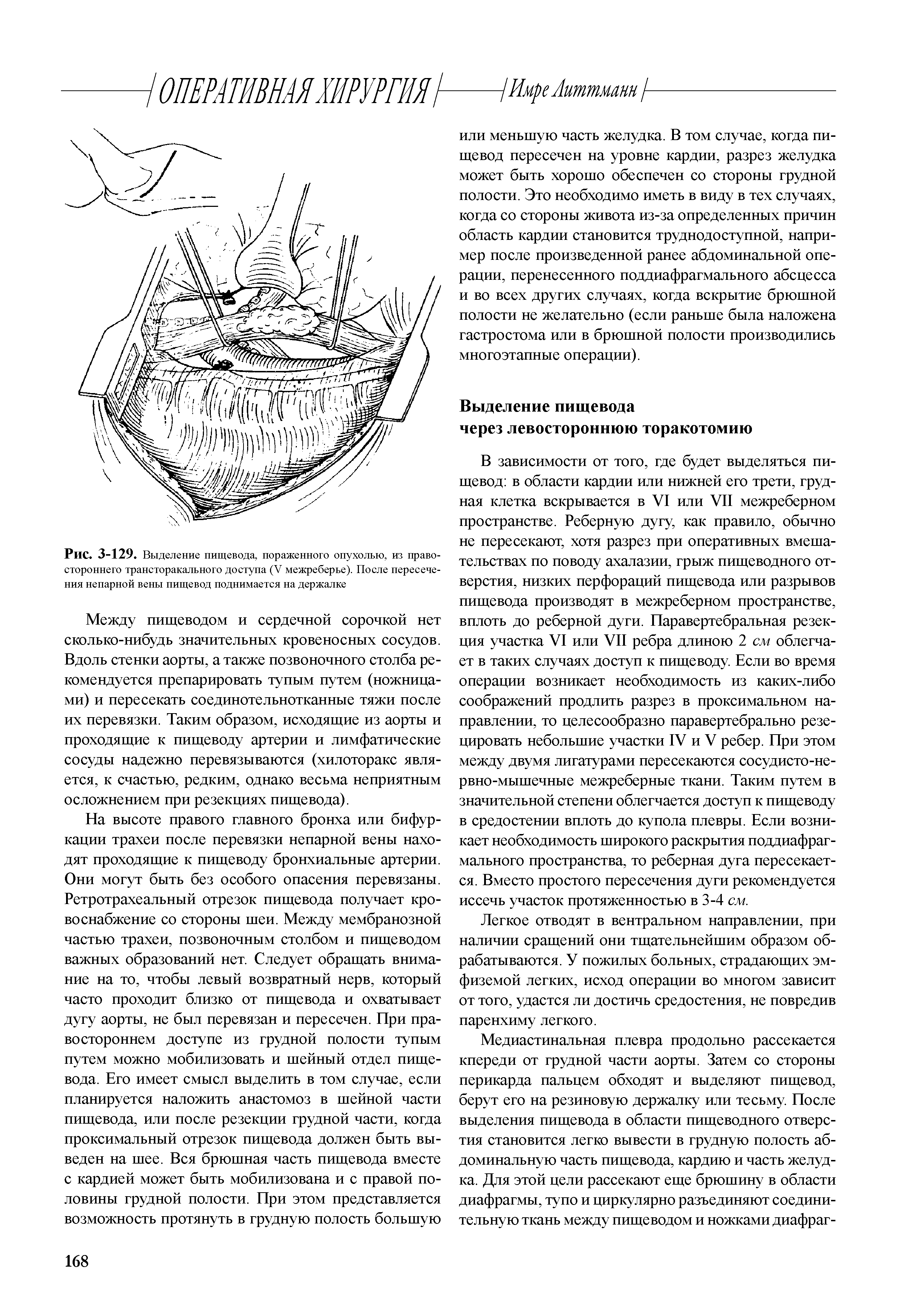 Рис. 3-129. Выделение пищевода, пораженного опухолью, из правостороннего трансторакального доступа (V межреберье). После пересечения непарной вены пищевод поднимается на держалке...