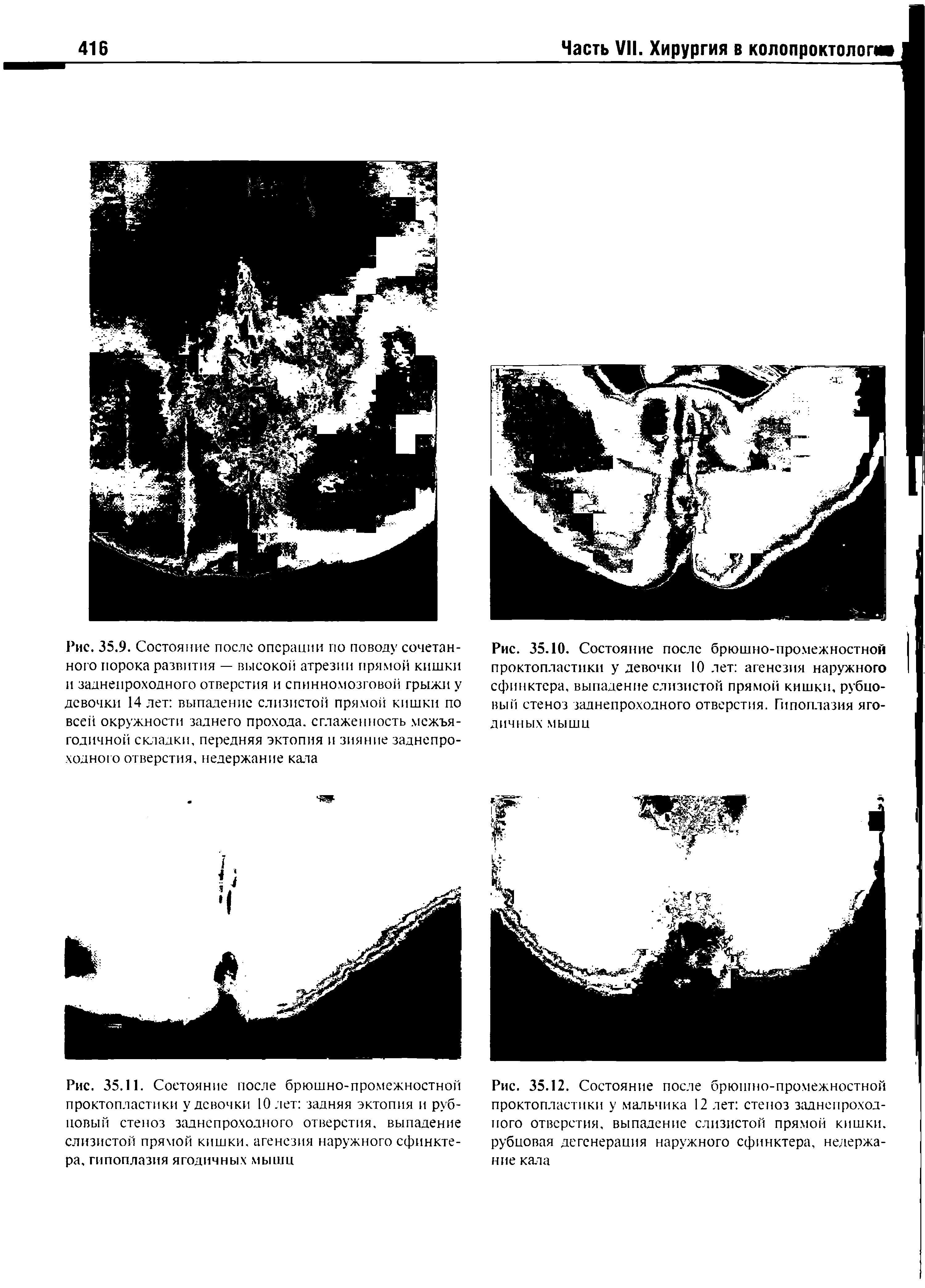 Рис. 35.11. Состояние после брюшно-промежностной проктопластики у девочки 10 лет задняя эктопия и рубцовый стеноз заднепроходного отверстия, выпадение слизистой прямой кишки, агенезия наружного сфинктера, гипоплазия ягодичных мышц...