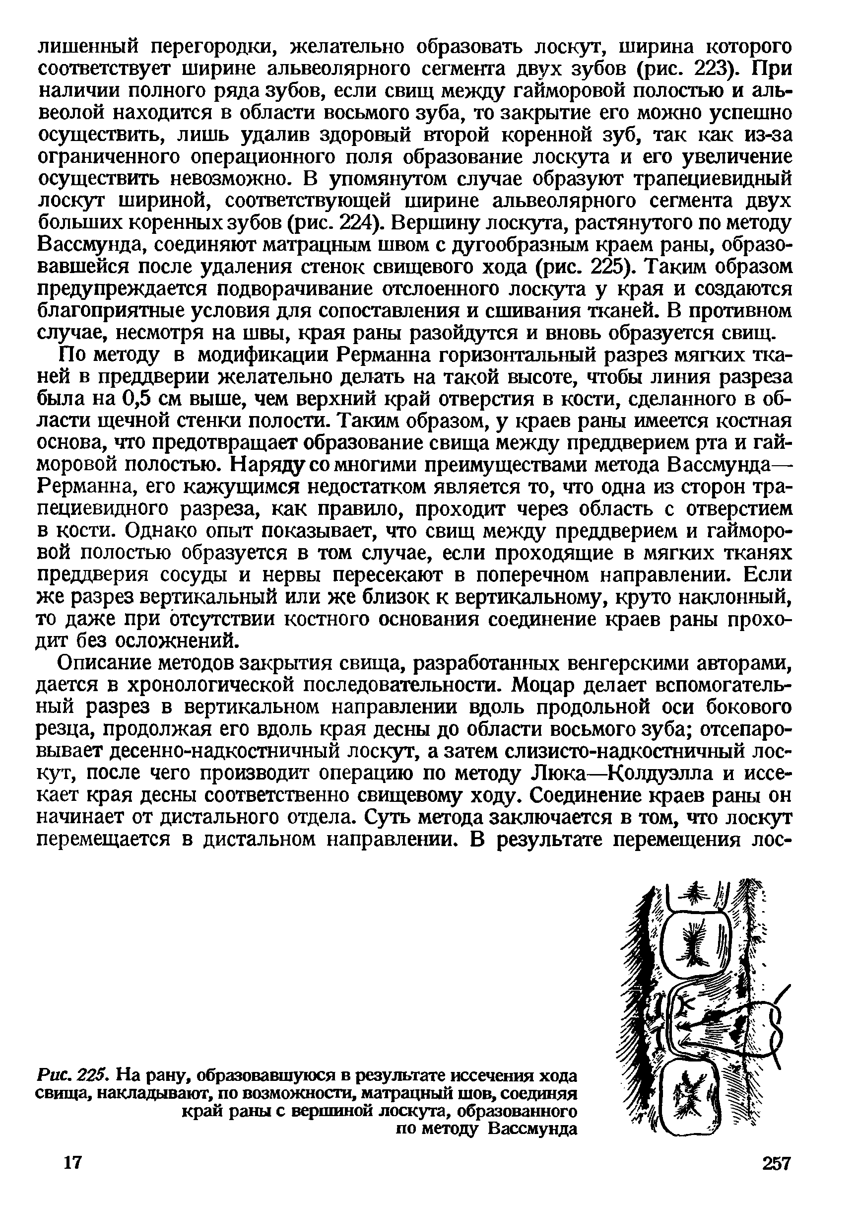 Рис. 225. На рану, образовавшуюся в результате иссечения хода свища, накладывают, по возможности, матрацный шов, соединяя край раны с вершиной лоскута, образованного по методу Вассмунда...