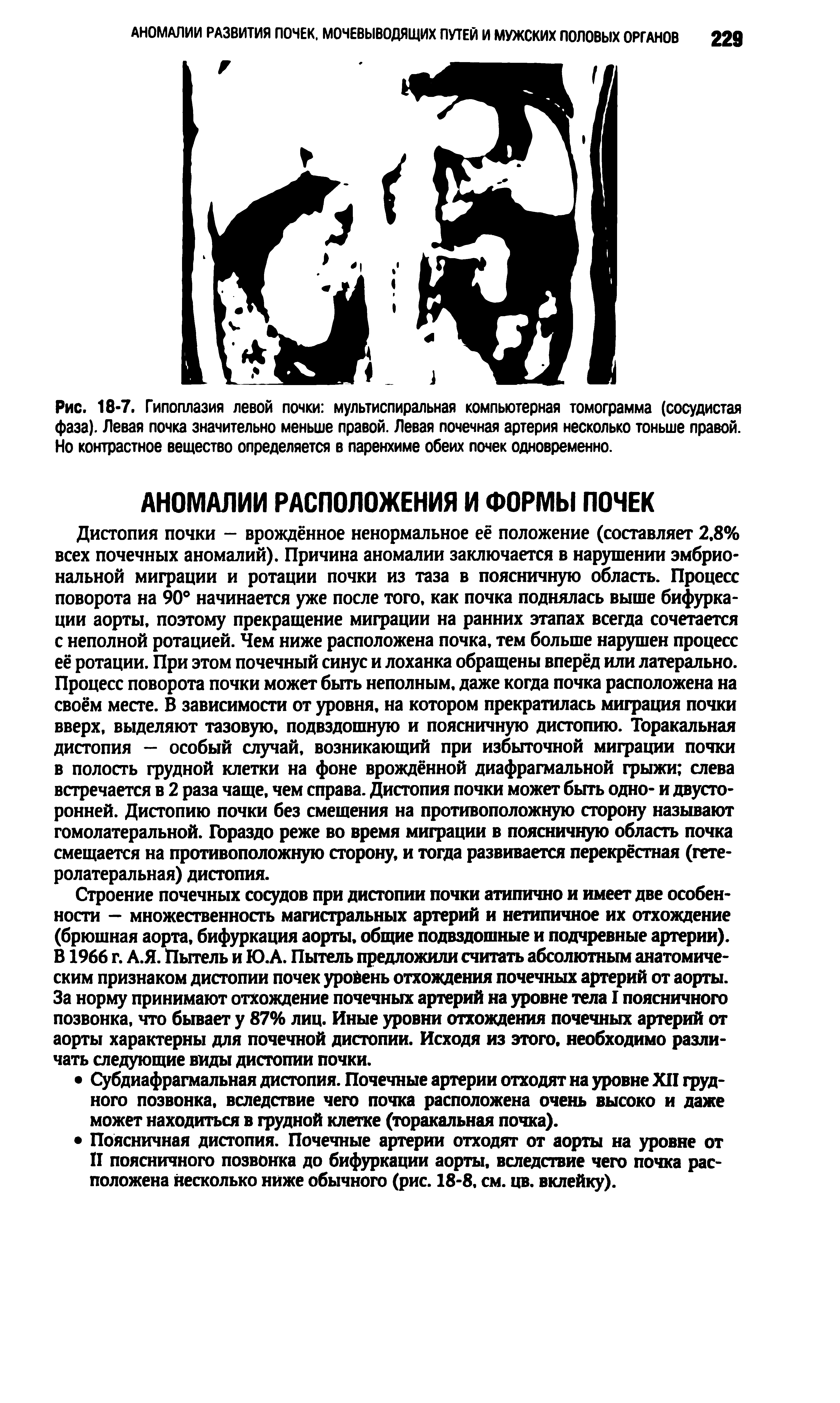 Рис. 18-7. Гипоплазия левой почки мультиспиральная компьютерная томограмма (сосудистая фаза). Левая почка значительно меньше правой. Левая почечная артерия несколько тоньше правой. Но контрастное вещество определяется в паренхиме обеих почек одновременно.