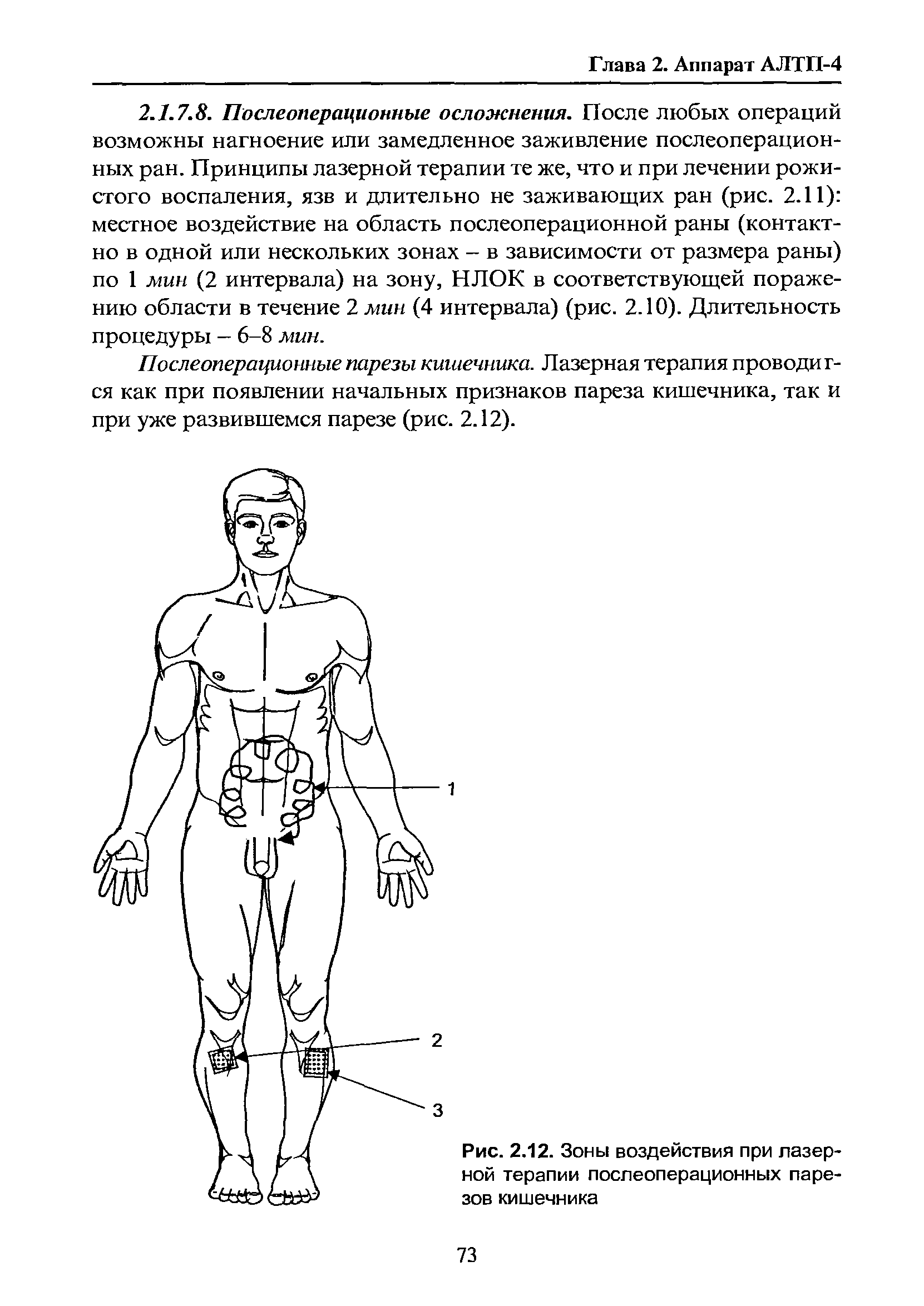 Рис. 2.12. Зоны воздействия при лазерной терапии послеоперационных парезов кишечника...