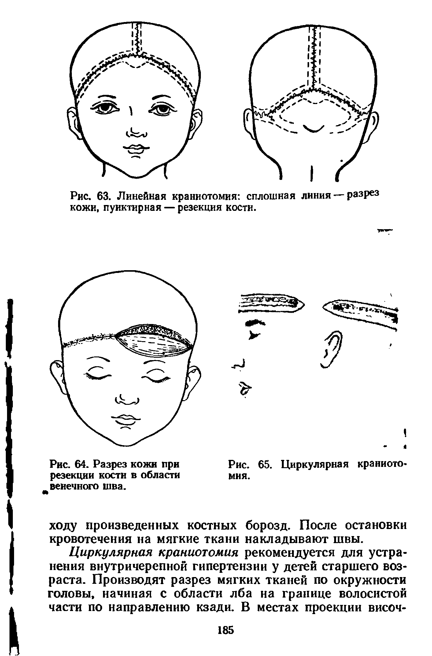 Рис. 64. Разрез кожи при резекции кости в области венечного шва.