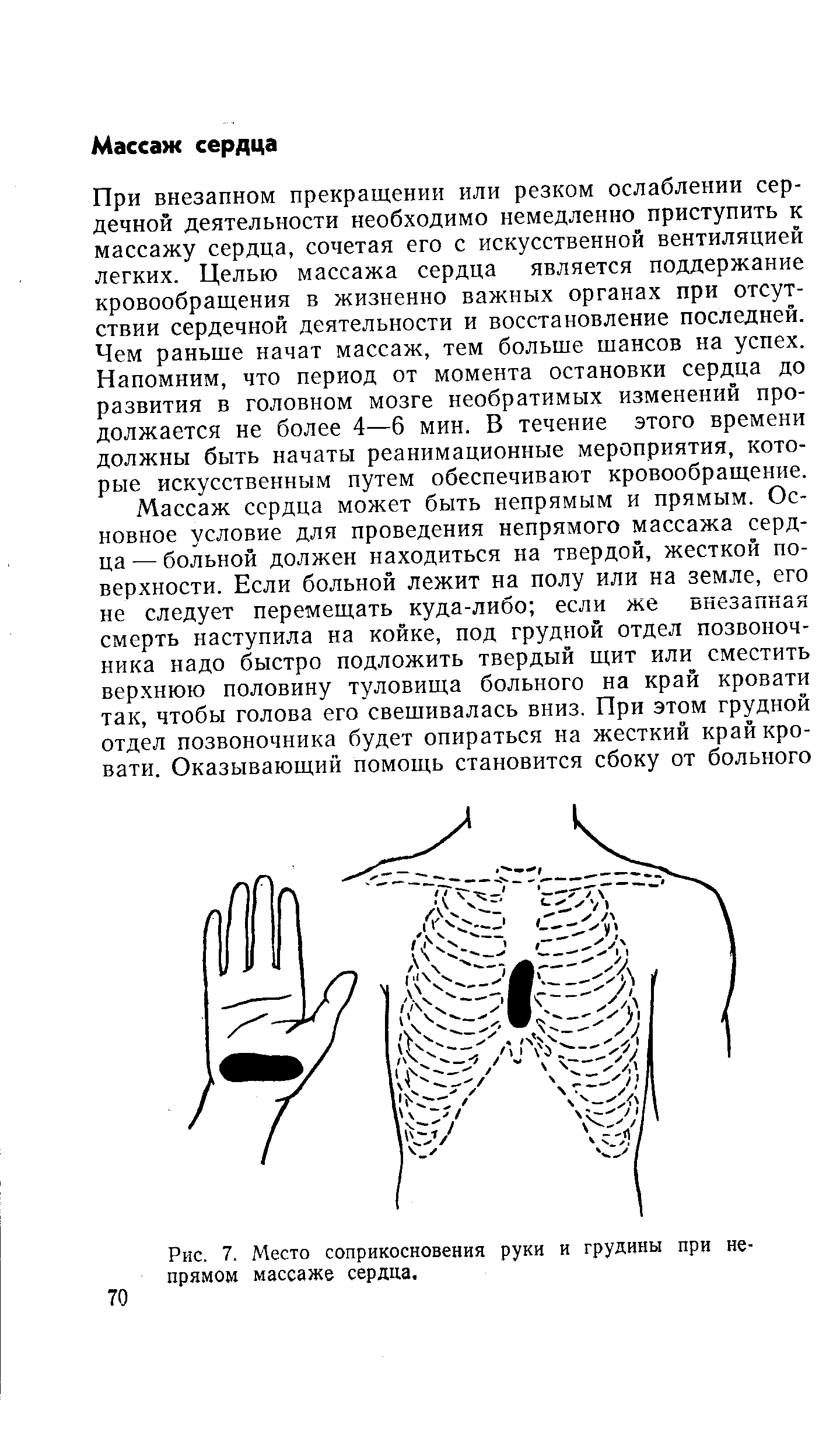 Рис. 7. Место соприкосновения руки и грудины при непрямом массаже сердца.