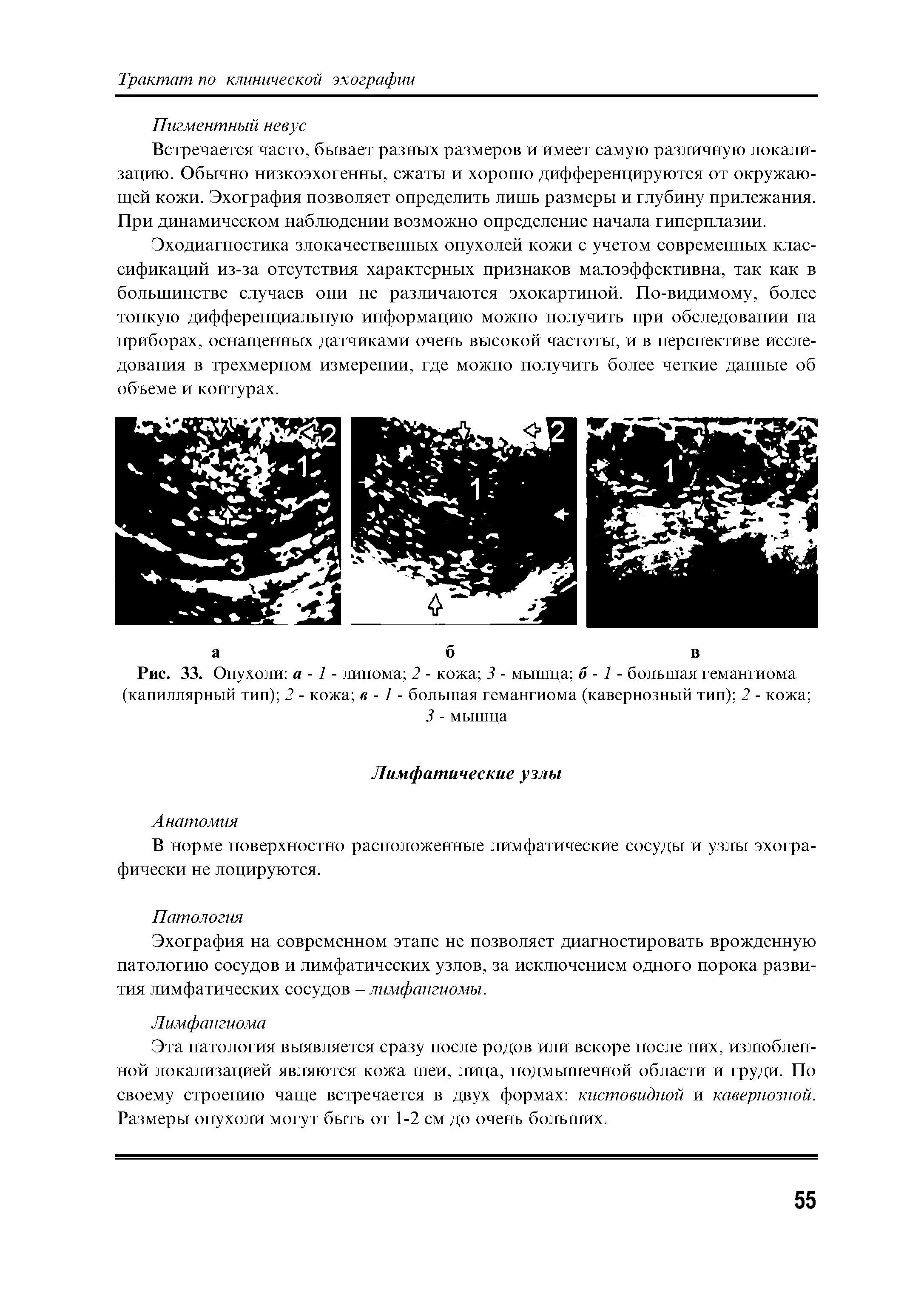 Рис. 33. Опухоли а -1 - липома 2 - кожа 3 - мышца б - 1 - большая гемангиома (капиллярный тип) 2 - кожа в -1 - большая гемангиома (кавернозный тип) 2 - кожа ...
