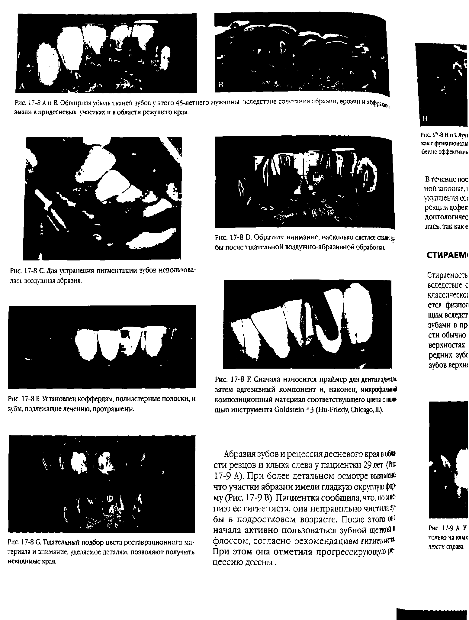 Рис. 17-8 С. Тщательный подбор цвета реставрационного материала и внимание, уделяемое деталям, позволяют получить невидимые края.