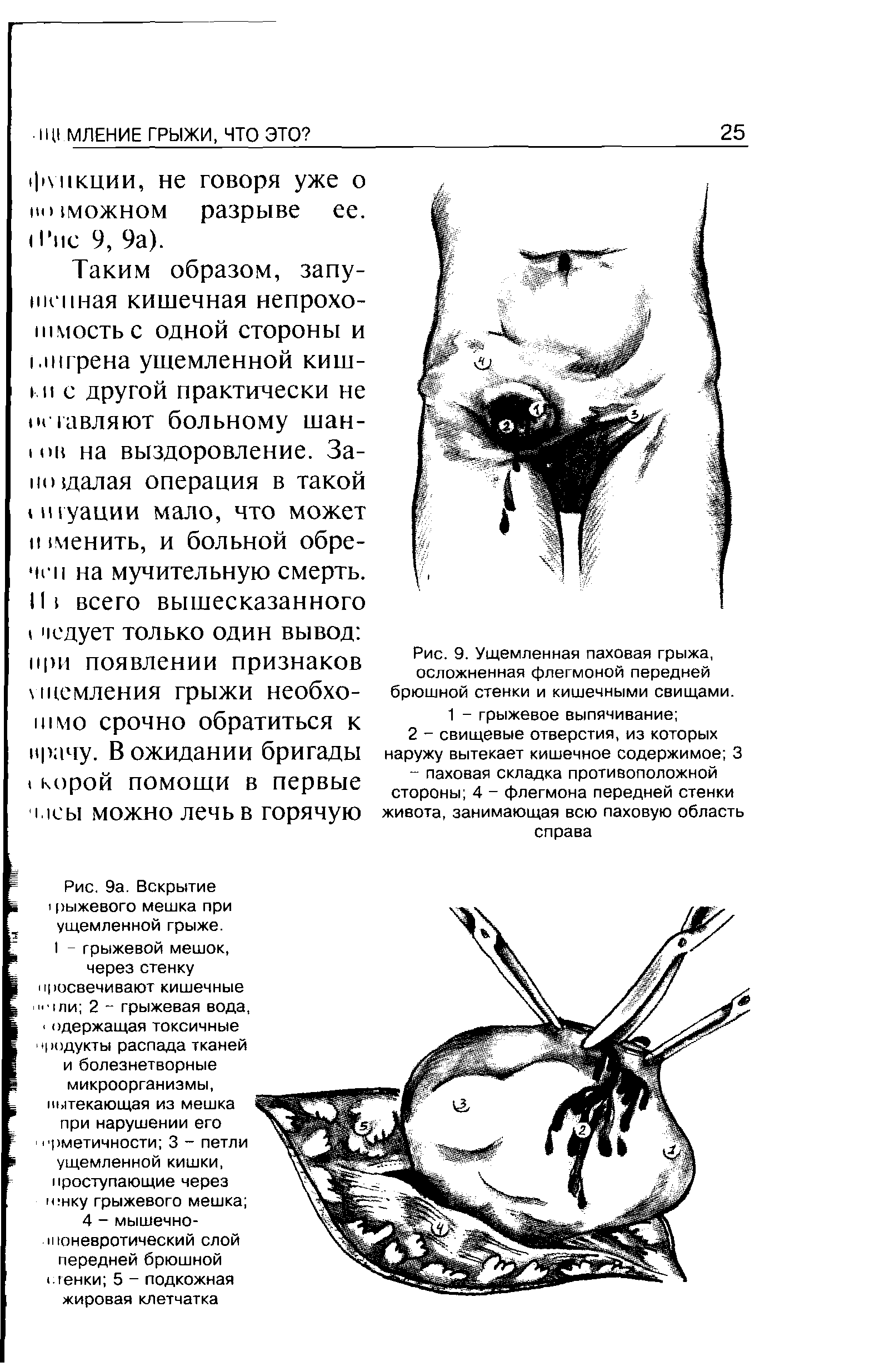 Рис. 9. Ущемленная паховая грыжа, осложненная флегмоной передней брюшной стенки и кишечными свищами.