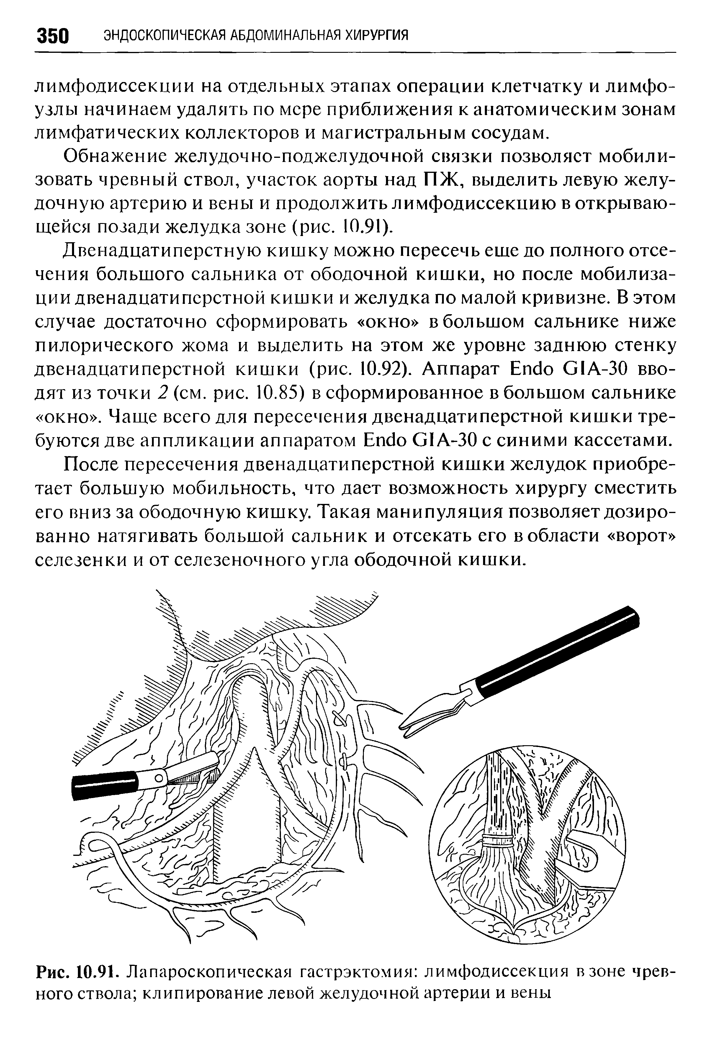 Рис. 10.91. Лапароскопическая гастрэктомия лимфодиссекция в зоне чревного ствола клипирование левой желудочной артерии и вены...