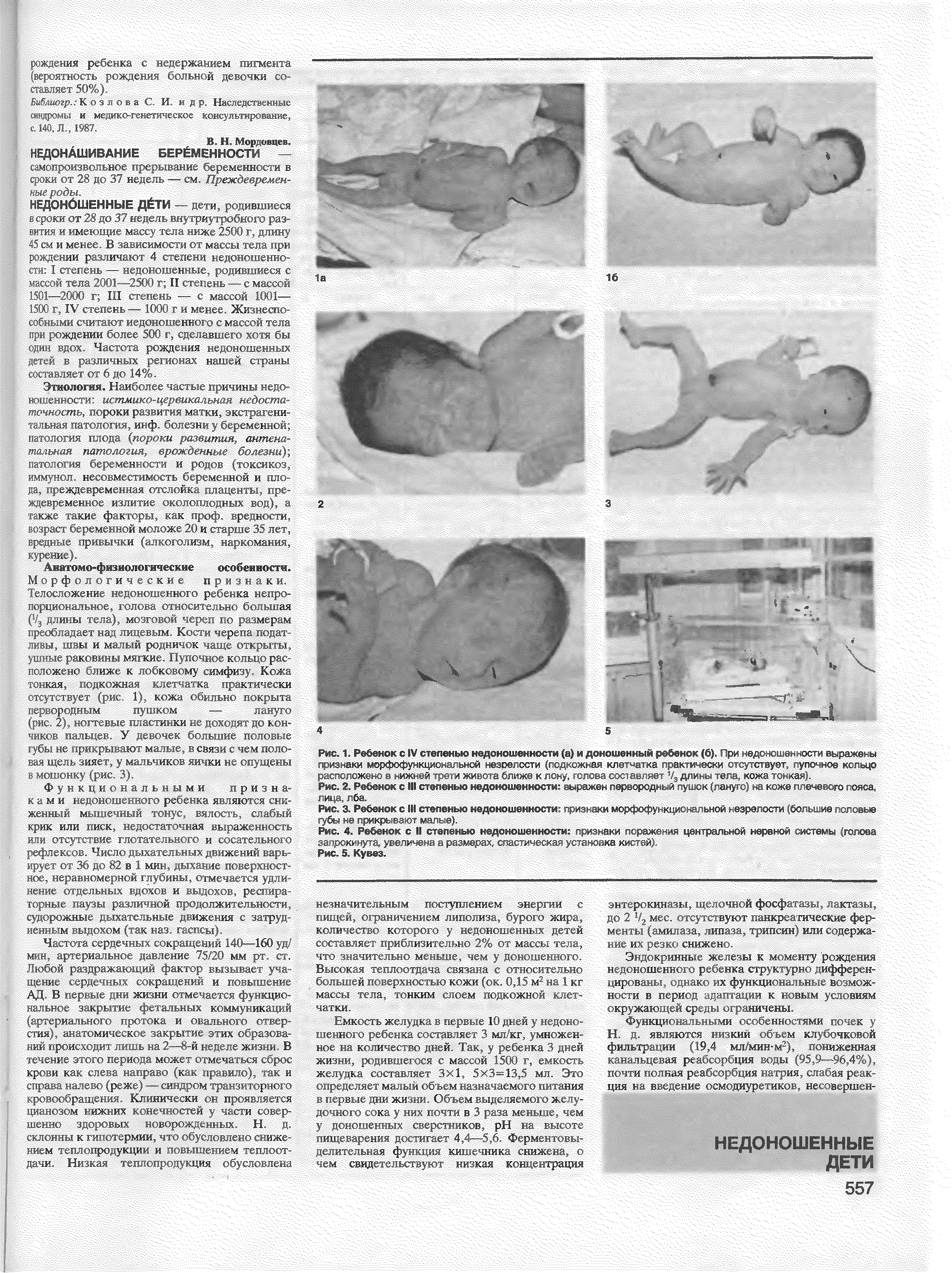 Рис. 3. Ребенок с III степенью недоношенности признаки морфофункционапьной незрелости (большие половые 5Ййф 1Я ВйЙ1В1ВЯяИ8вг оИЙЙВИй й зняф Й фн Дн й й 0 нб гвОЯЯ8 Ива1 запрокинута, увеличена а размерах, спастическая установка кистей).