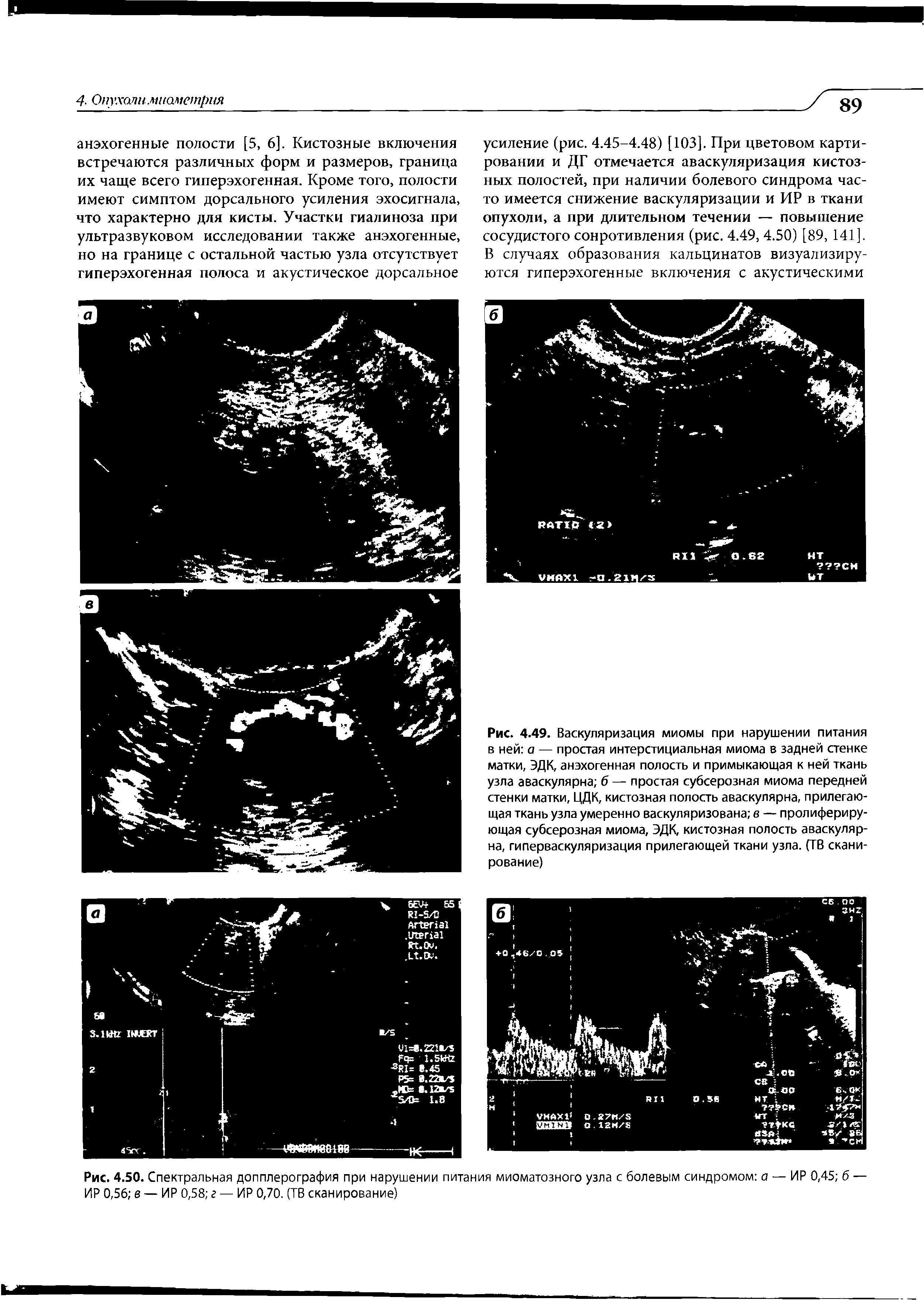 Рис. 4.50. Спектральная допплерография при нарушении питания миоматозного узла с болевым синдромом а — ИР 0,45 б — ИР 0,56 в — ИР 0,58 г — ИР 0,70. (ТВ сканирование)...