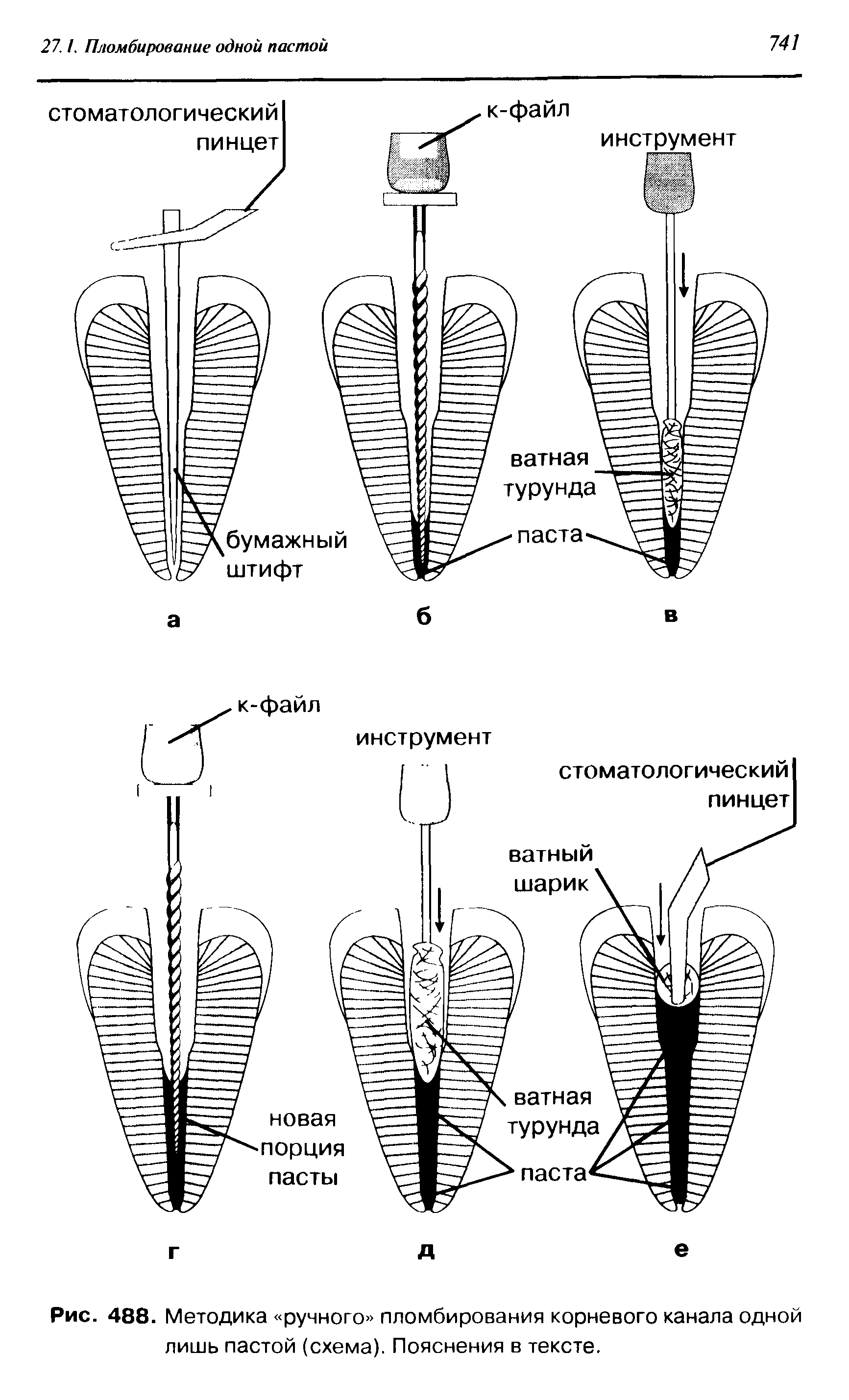Рис. 488. Методика ручного пломбирования корневого канала одной лишь пастой (схема). Пояснения в тексте.
